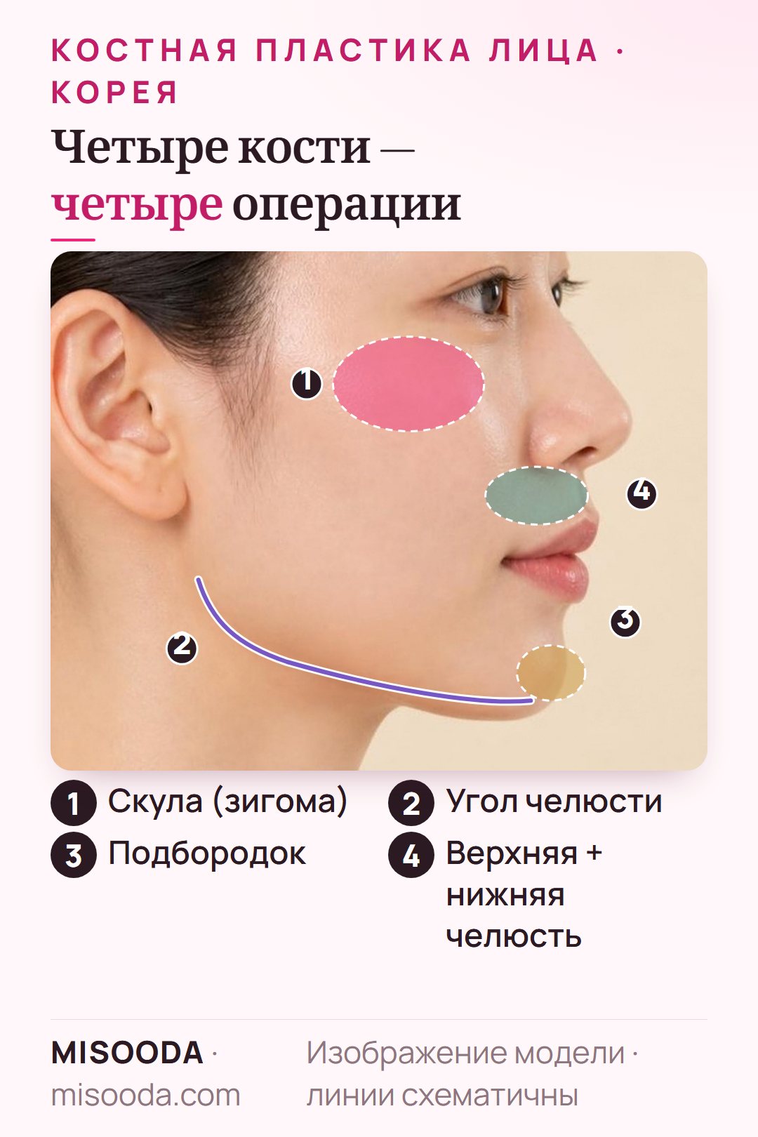 Зоны костной пластики лица в профиль: редукция скул (зигома), угол челюсти для V-line, гениопластика подбородка, верхняя и нижняя челюсть при двухчелюстной операции