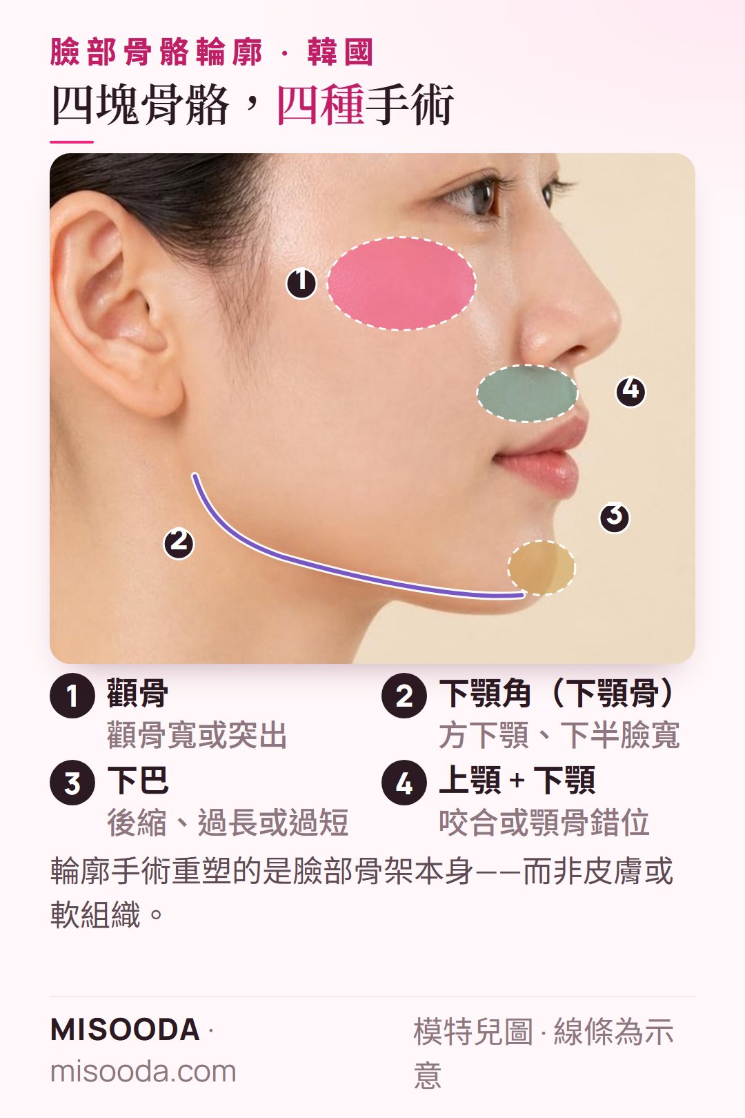 韓國臉部骨骼輪廓部位側臉示意:顴骨縮小、V臉的下顎角、頦成形術的下巴,以及雙顎手術的上下顎