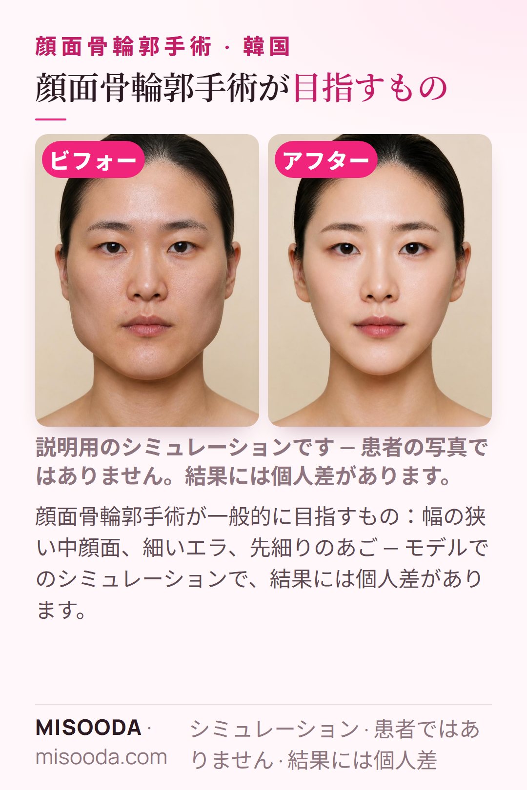 韓国 顔面骨輪郭手術が一般的に目指すもの — 幅の狭い中顔面、細いエラ、先細りのあご — をモデルでシミュレーションしたイラスト