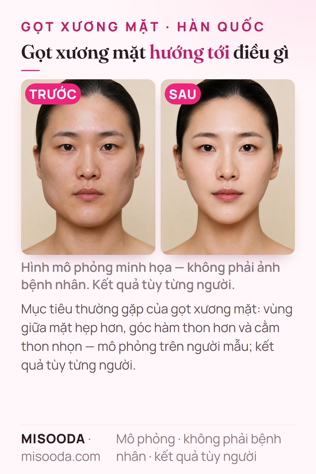 Minh họa mục tiêu thường gặp của gọt xương mặt Hàn Quốc — vùng giữa mặt hẹp hơn, góc hàm thon hơn và cằm thon nhọn — mô phỏng trên người mẫu