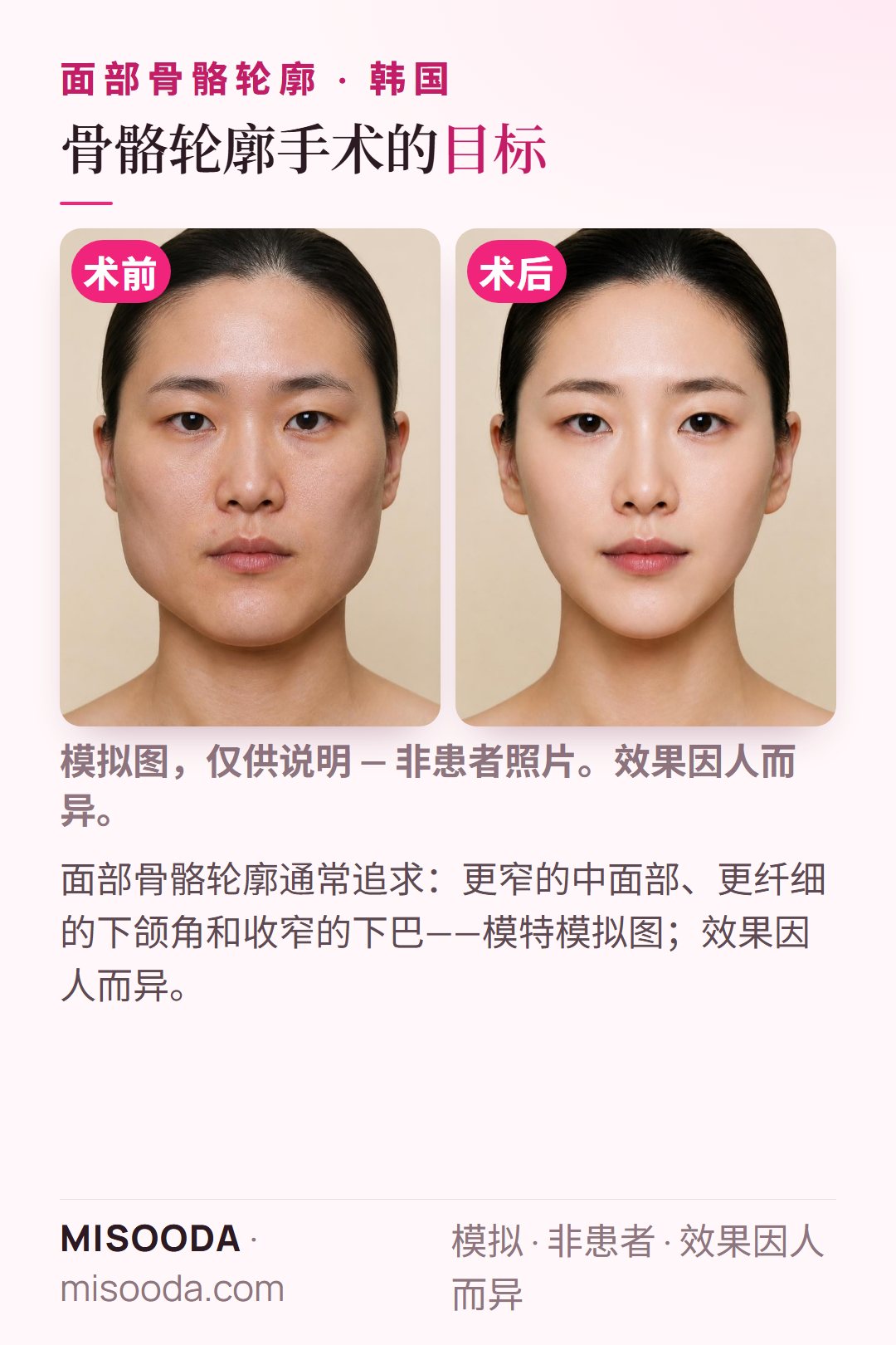 韩国面部骨骼轮廓典型目标示意:更窄的中面部、更纤细的下颌角和收窄的下巴——模特模拟图
