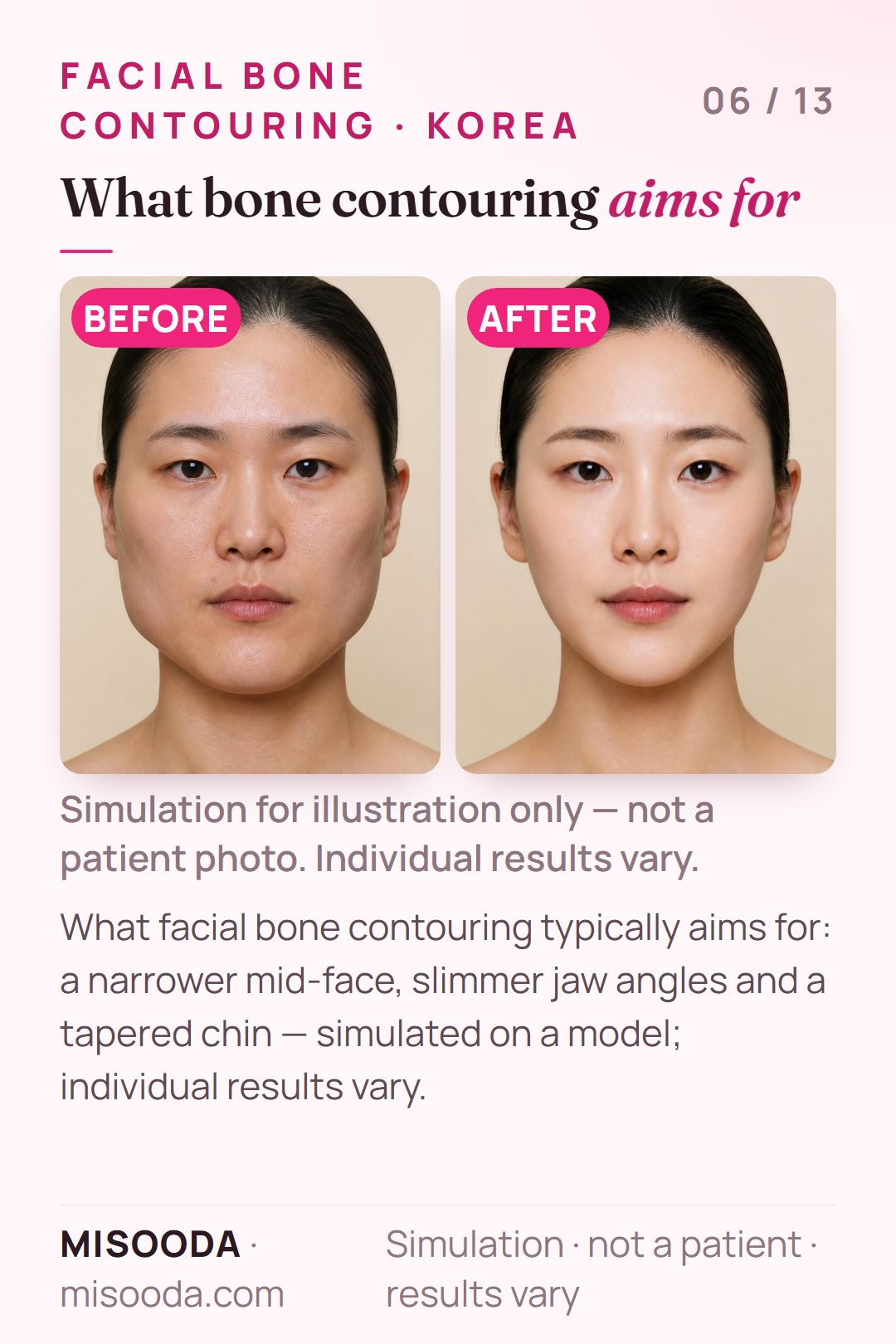 Illustration of the typical goals of facial bone contouring — a narrower mid-face, slimmer jaw angles and a tapered chin — simulated on a model