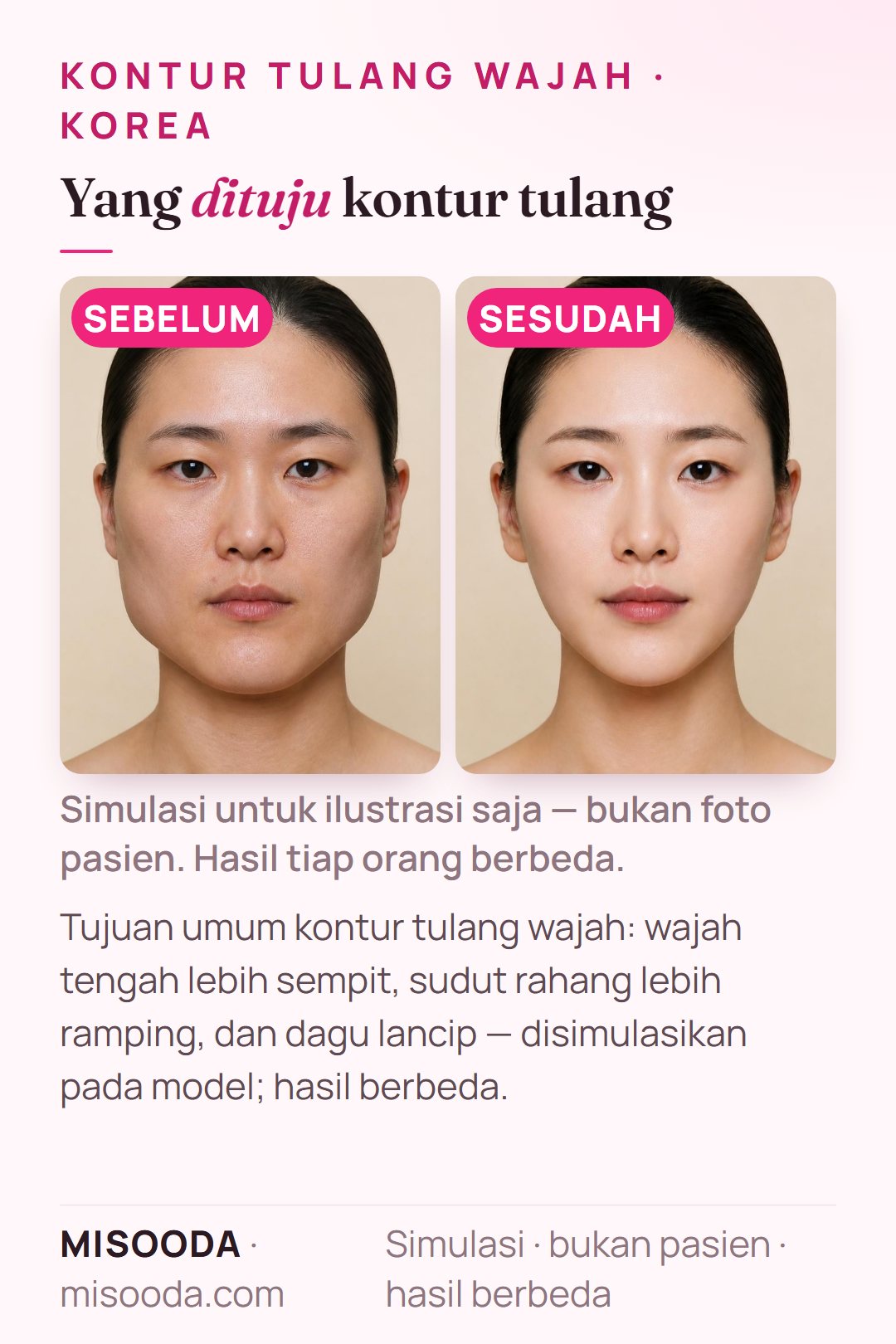 Ilustrasi tujuan umum kontur tulang wajah di Korea — wajah tengah lebih sempit, sudut rahang lebih ramping, dan dagu lancip — disimulasikan pada model