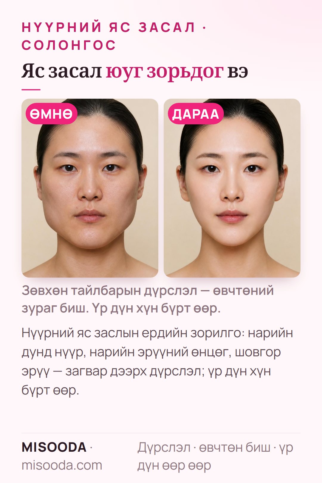 Нүүрний яс заслын ердийн зорилго — нарийн дунд нүүр, нарийн эрүүний өнцөг, шовгор эрүү — загвар дээрх дүрслэл, Солонгост нүүрний яс засал