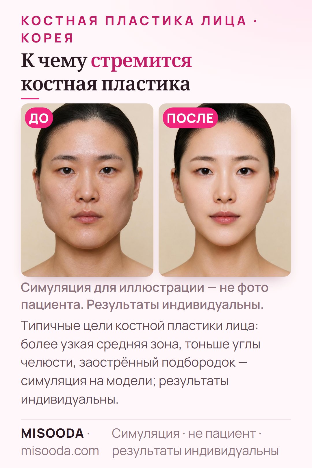 Иллюстрация типичных целей костной контурной пластики лица — более узкая средняя зона, тоньше углы челюсти и заострённый подбородок — симуляция на модели