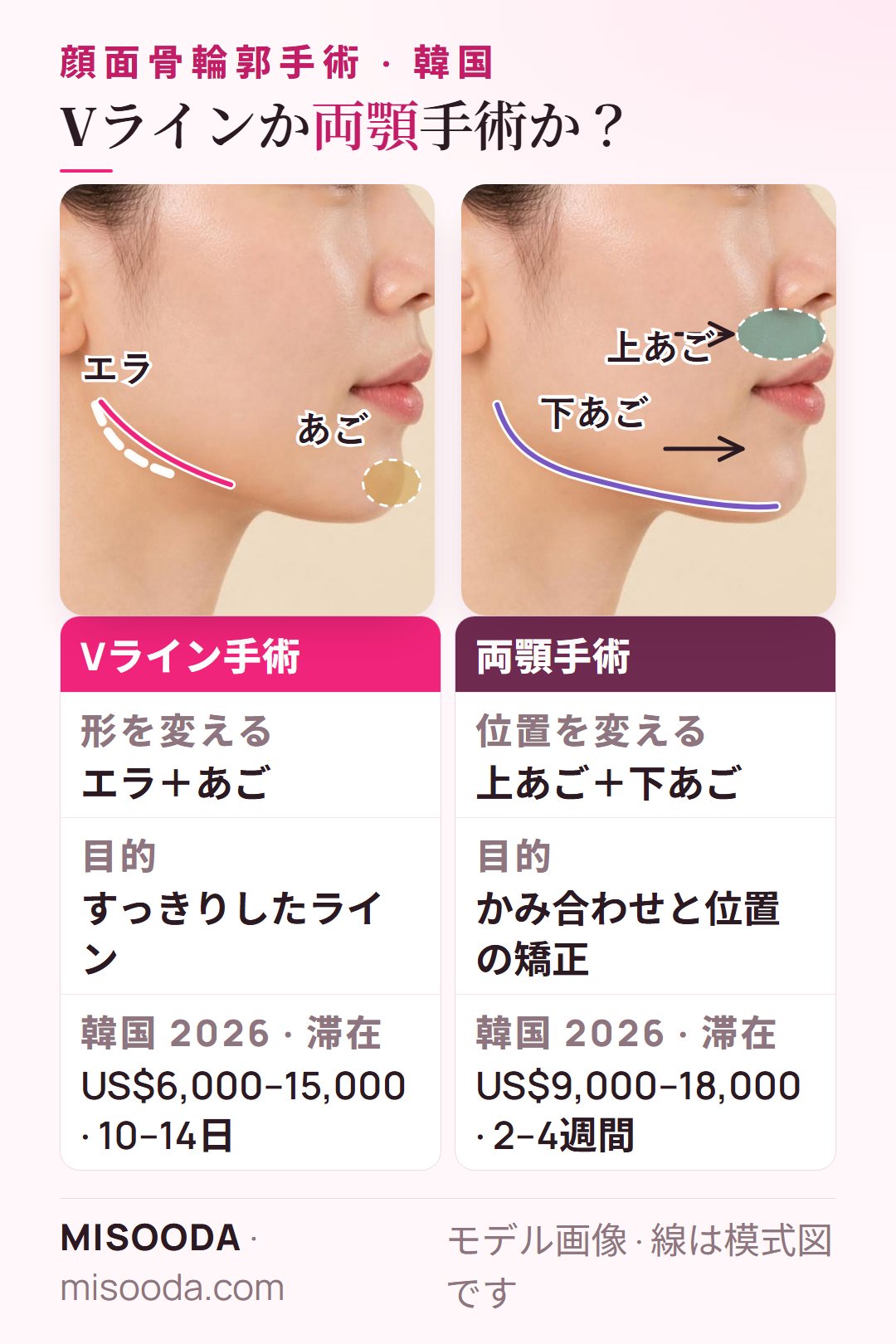 韓国 Vライン手術と両顎手術を横顔で比較:Vラインはエラとあごの形を変え(US$6,000–15,000)、両顎は上下のあごの位置を変える(US$9,000–18,000)