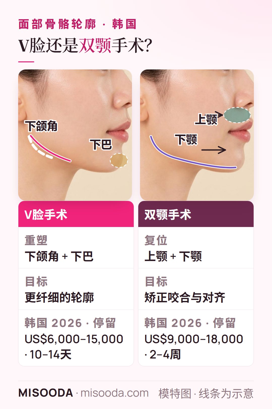 韩国 V脸手术与双颚手术侧面对比:V脸重塑下颌角和下巴(US$6,000–15,000),双颚将上下颚复位(US$9,000–18,000)