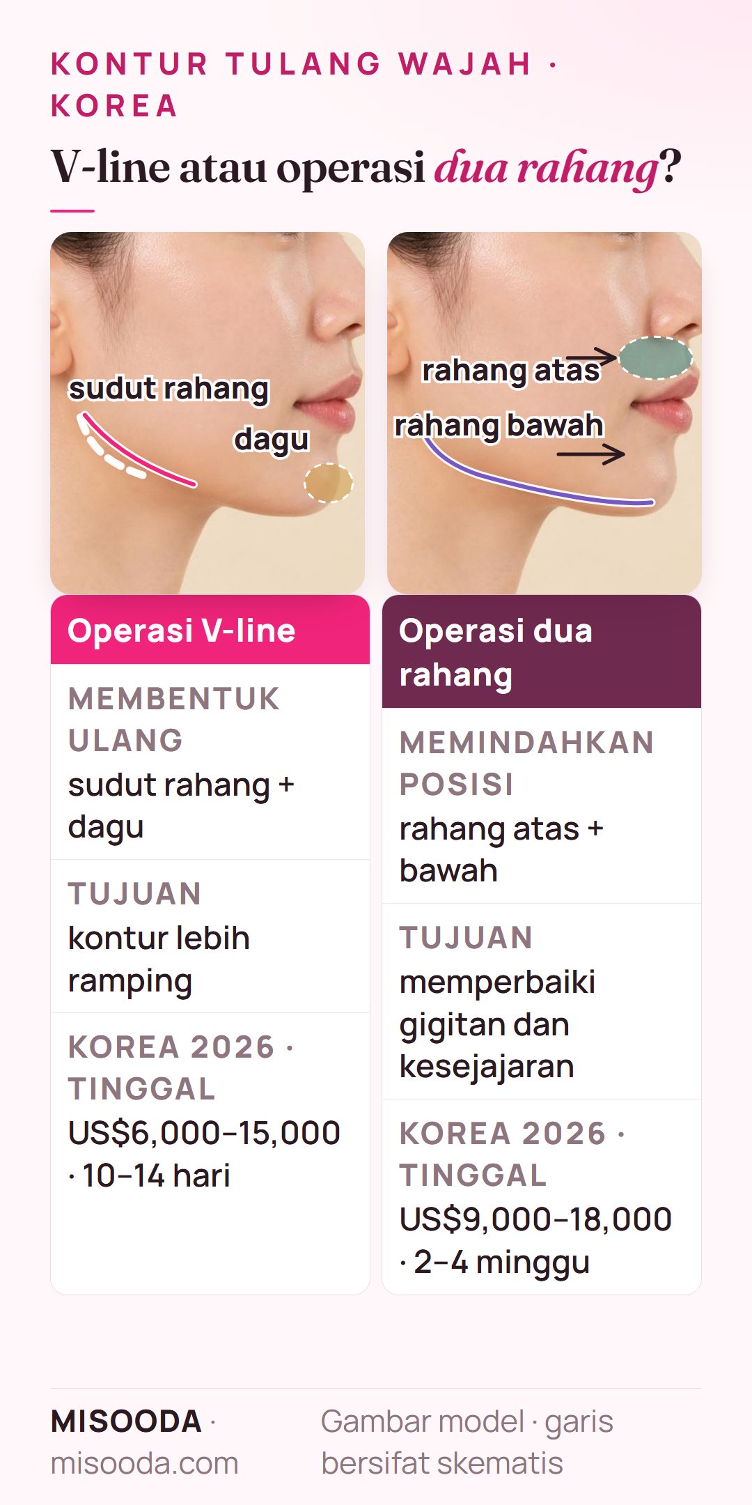 Operasi V-line vs operasi dua rahang di Korea pada profil samping: V-line membentuk sudut rahang dan dagu (US$6,000–15,000), dua rahang memindahkan kedua rahang (US$9,000–18,000)