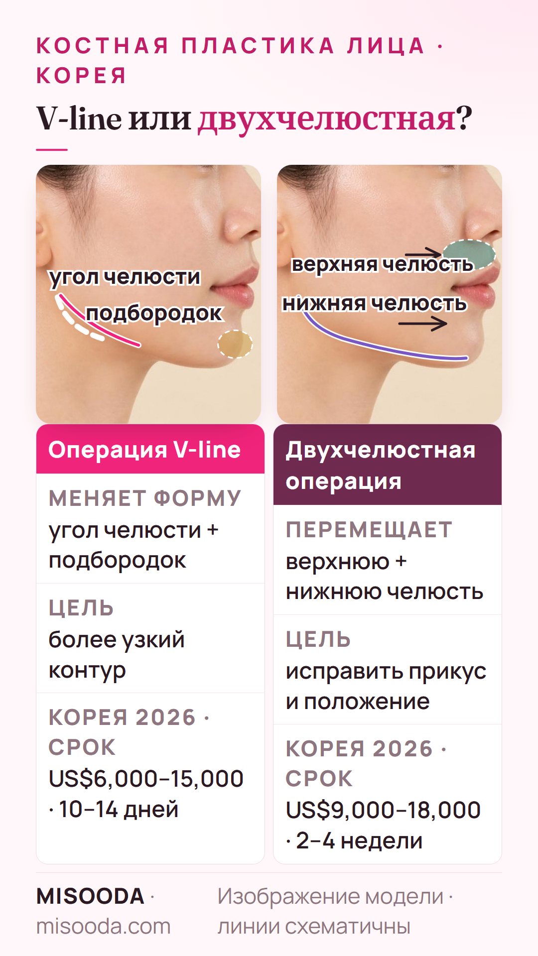 Операция V-line и двухчелюстная операция в профиль: V-line меняет угол челюсти и подбородок (US$6,000–15,000), двухчелюстная перемещает обе челюсти (US$9,000–18,000)