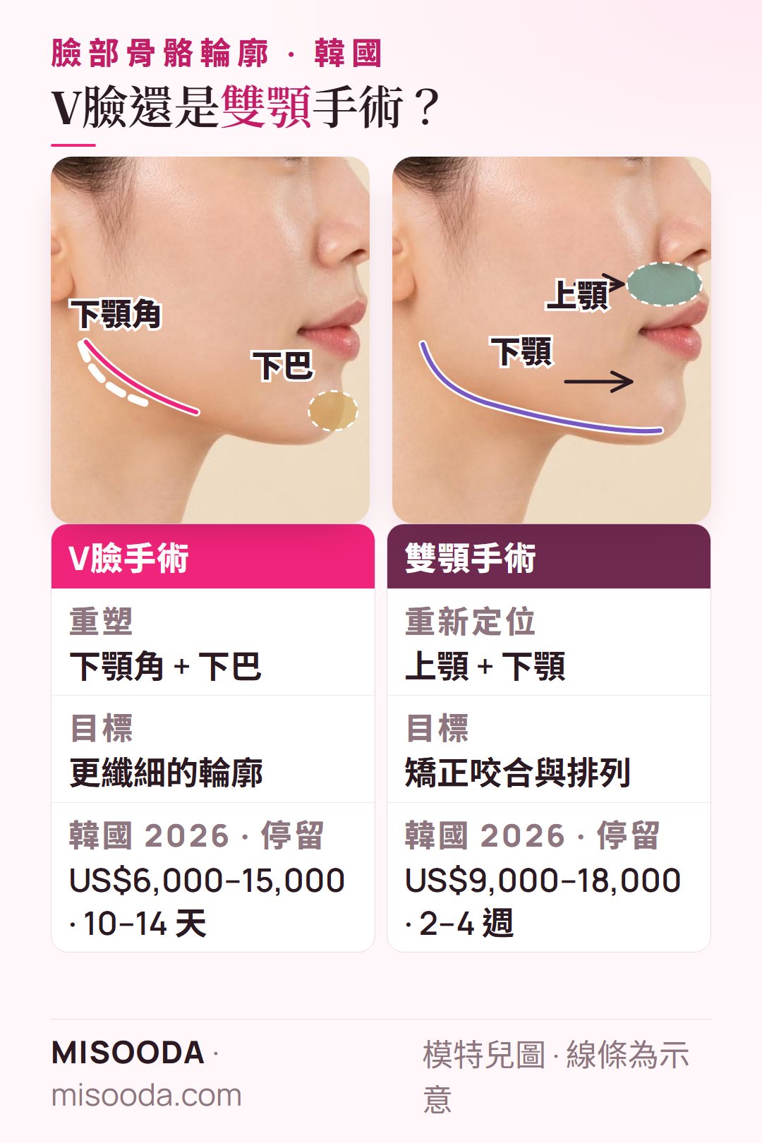 韓國 V臉手術 vs 雙顎手術側臉示意:V臉重塑下顎角與下巴(US$6,000–15,000),雙顎重新定位上下顎(US$9,000–18,000)