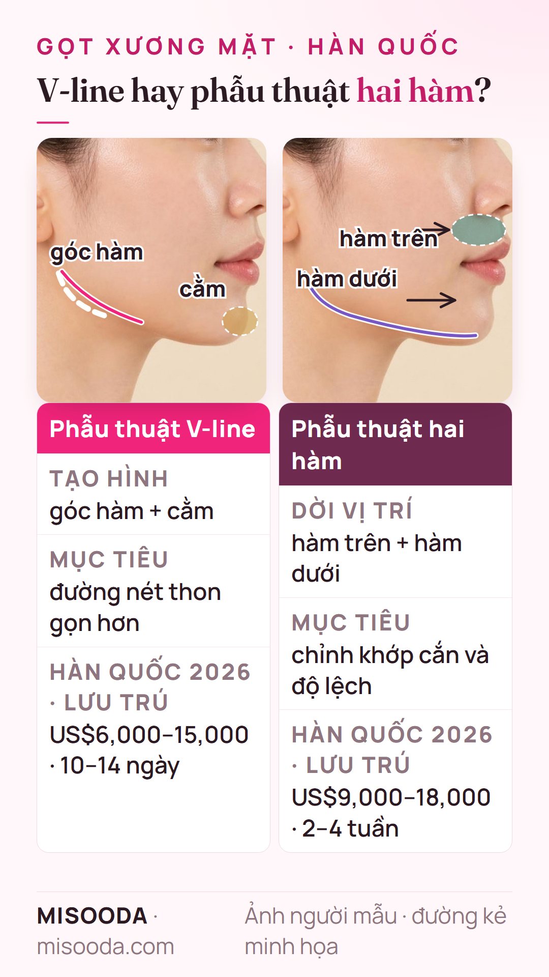 Phẫu thuật V-line và phẫu thuật hai hàm trên góc nghiêng: V-line tạo hình góc hàm và cằm (US$6,000–15,000), hai hàm dời vị trí cả hai hàm (US$9,000–18,000)