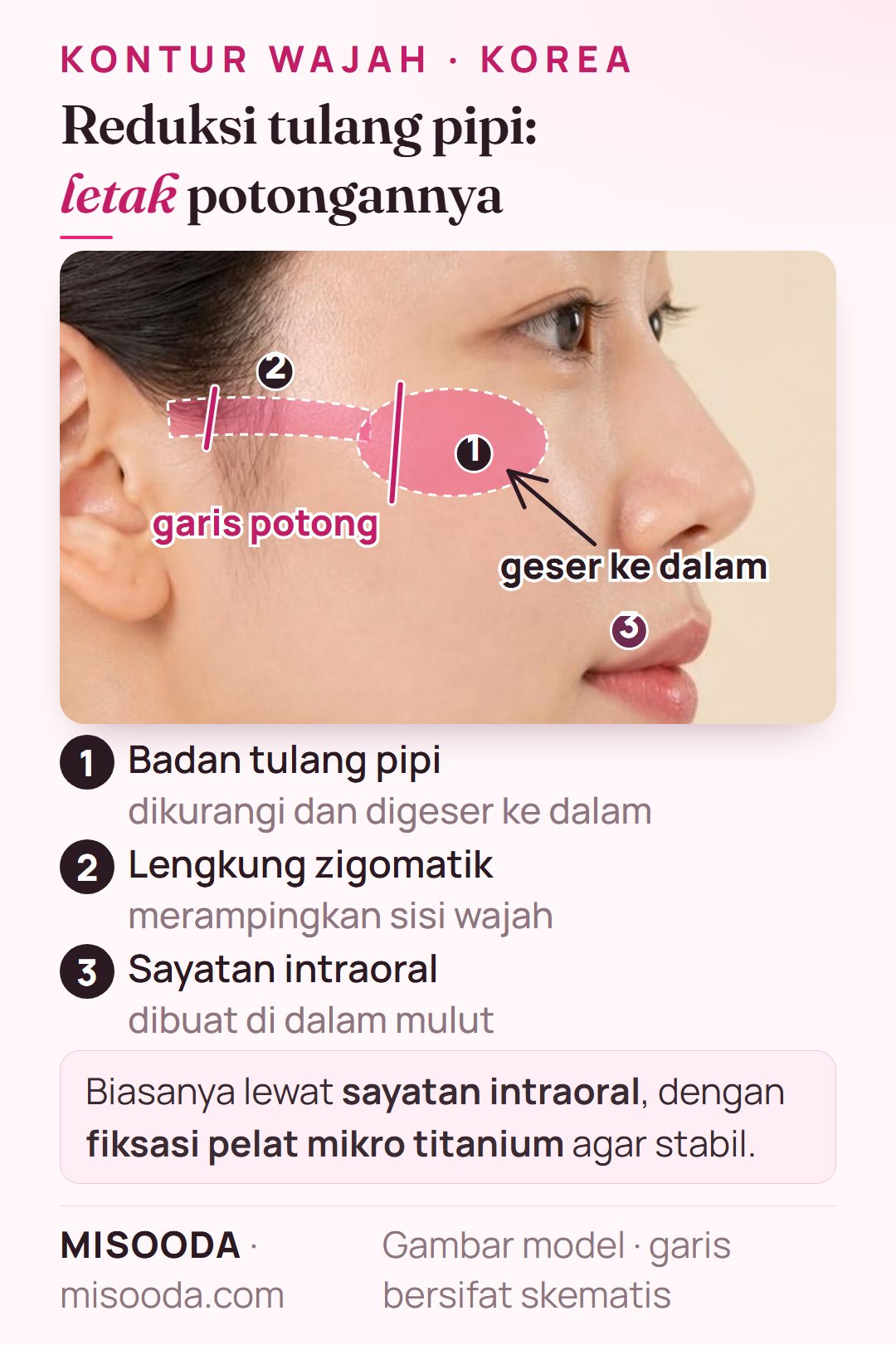 Reduksi tulang pipi (zigoma) di Korea: garis potong badan tulang pipi dan lengkung zigomatik digeser ke dalam lewat sayatan intraoral dengan pelat mikro titanium
