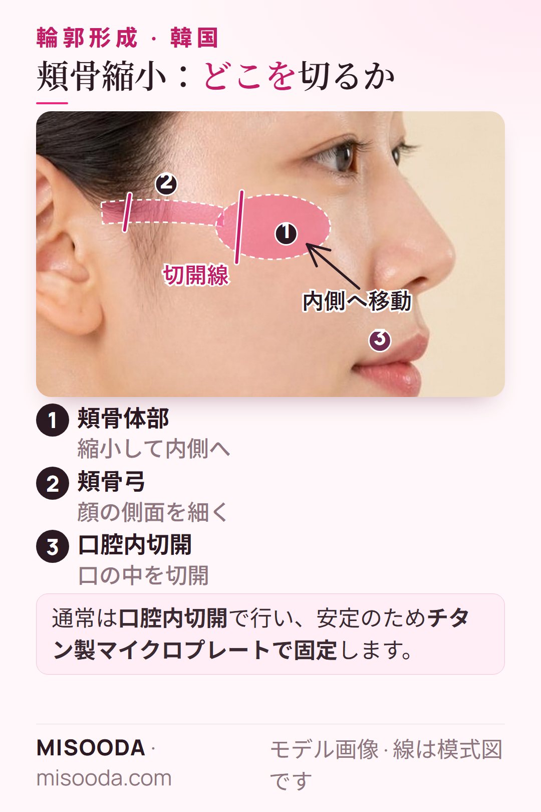韓国 頬骨縮小術:口腔内切開で頬骨体部と頬骨弓の切開線を内側へ移動し、チタン製マイクロプレートで固定