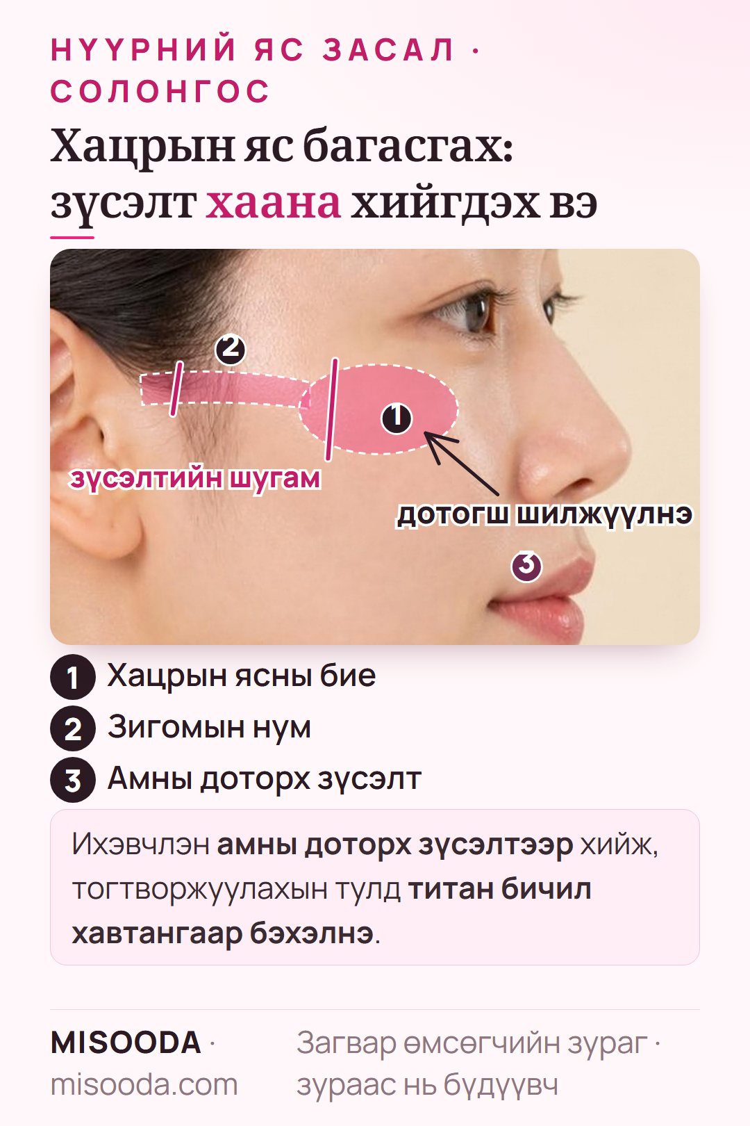 Солонгост хацрын яс (зигома) багасгах: хацрын ясны бие ба зигомын нумын зүсэлтийн шугам, амны доторх зүсэлтээр дотогш шилжүүлж титан хавтангаар бэхэлнэ