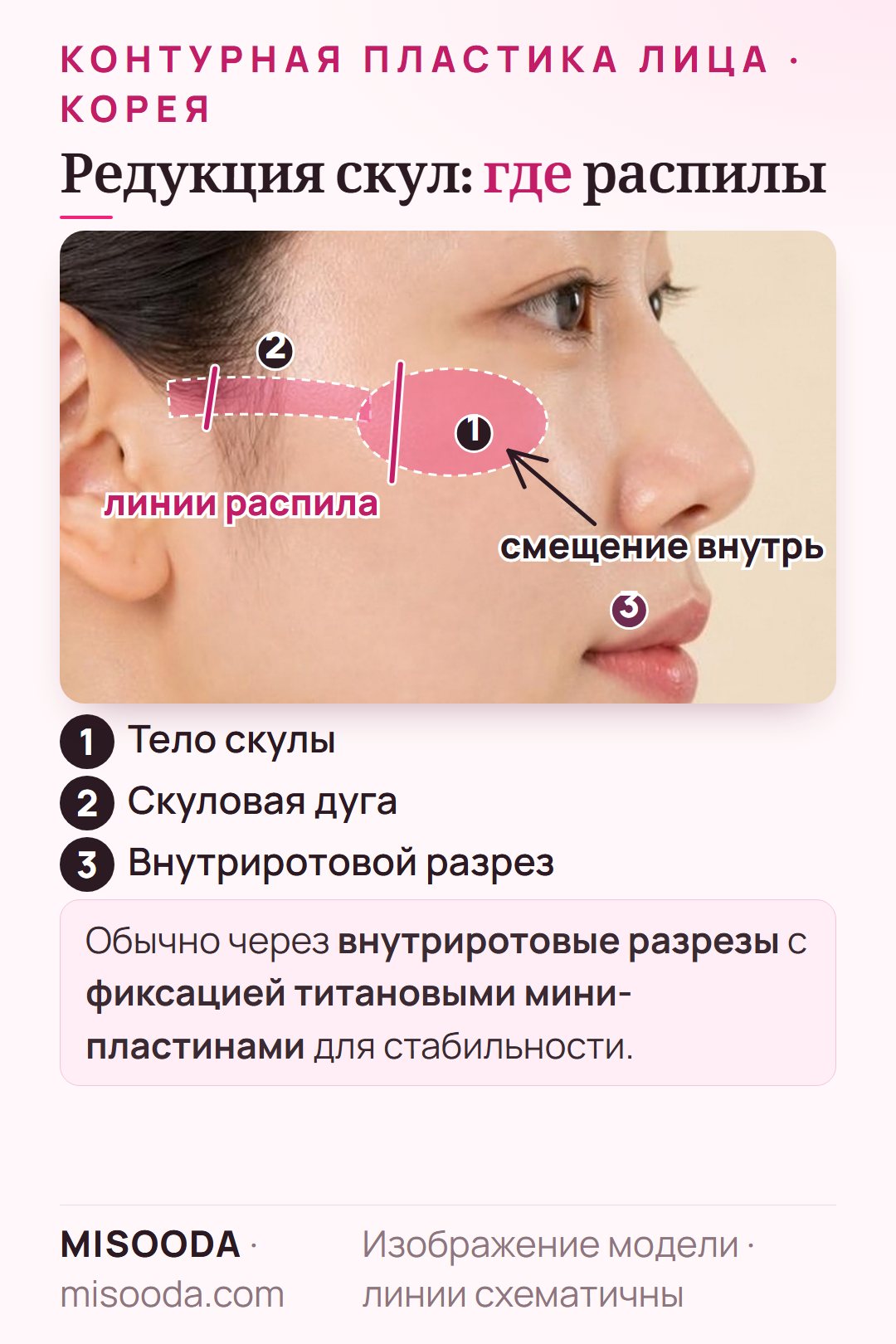 Редукция скул в Корее: линии распила тела скуловой кости и скуловой дуги смещаются внутрь через внутриротовые разрезы с фиксацией титановыми микропластинами