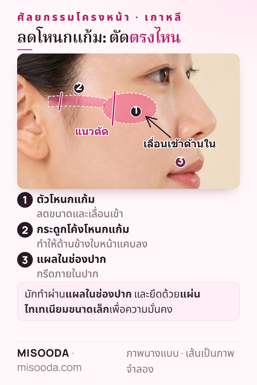 ลดโหนกแก้ม (zygoma) เกาหลี: แนวตัดตัวโหนกแก้มและกระดูกโค้งเลื่อนเข้าด้านในผ่านแผลในช่องปาก ยึดด้วยแผ่นไทเทเนียมขนาดเล็ก
