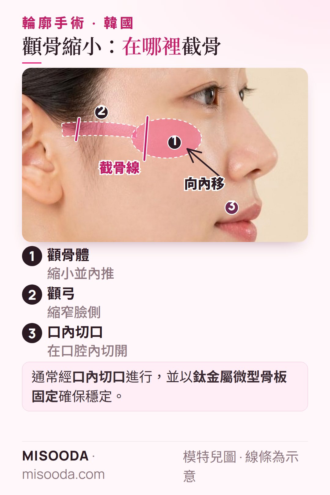 韓國 顴骨縮小手術:經口內切口將顴骨體與顴弓沿截骨線向內推,並以鈦金屬微型骨板固定以確保穩定