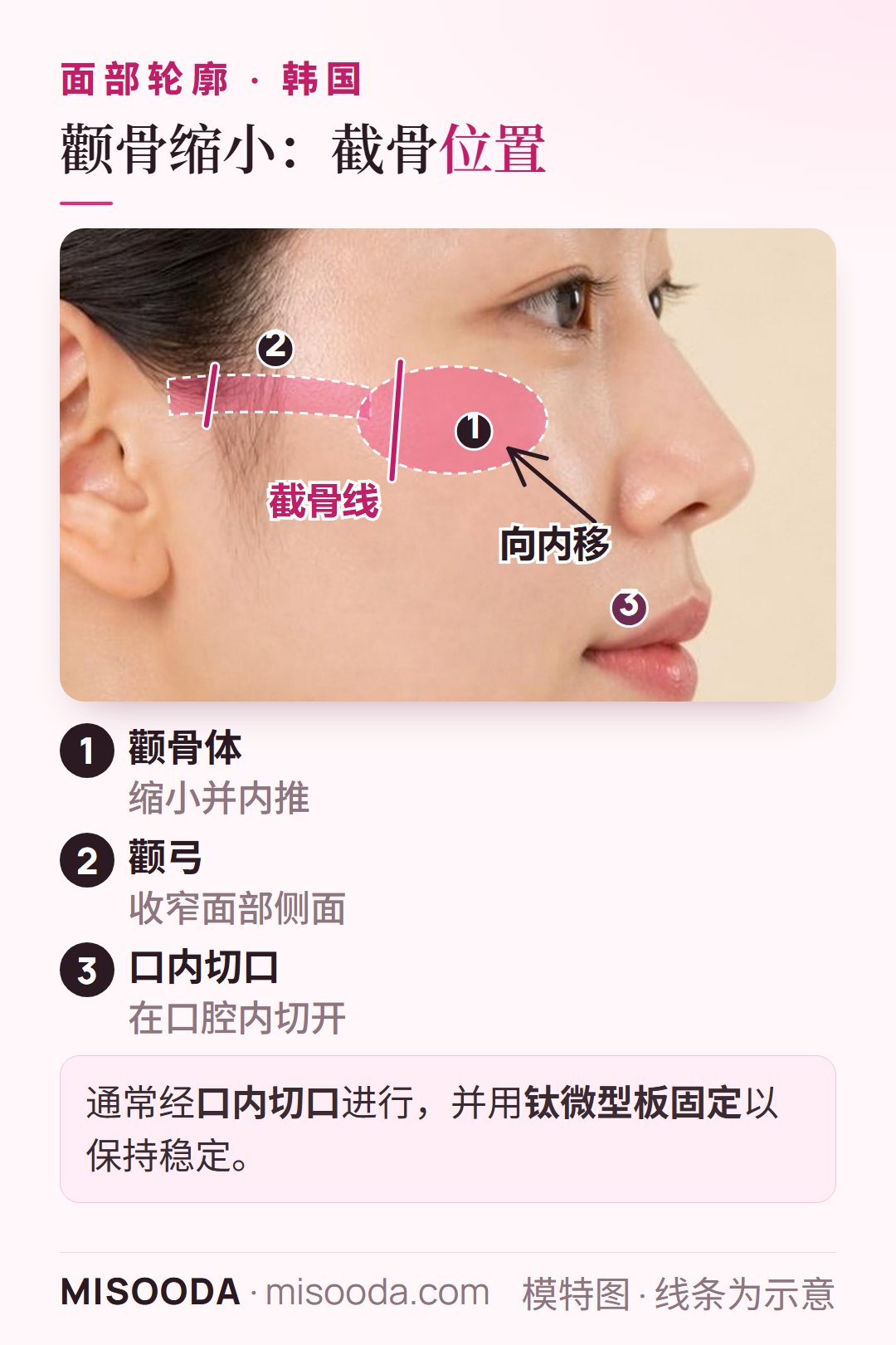 韩国 颧骨缩小手术图解:经口内切口沿截骨线将颧骨体与颧弓向内推移,并用钛微型板固定以保持稳定