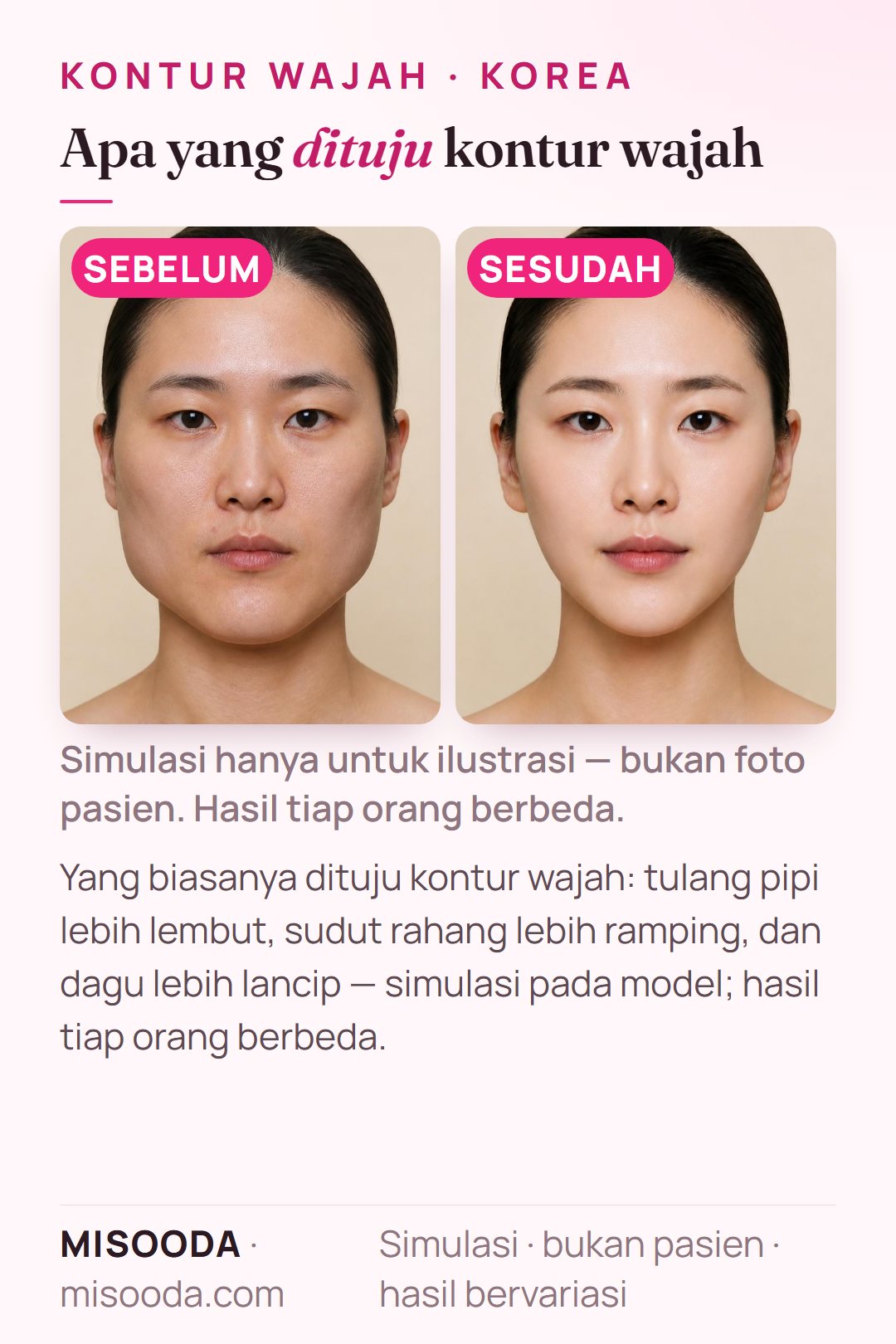 Ilustrasi tujuan umum operasi kontur wajah di Korea — tulang pipi lebih lembut, sudut rahang lebih ramping, dan dagu lancip — disimulasikan pada model