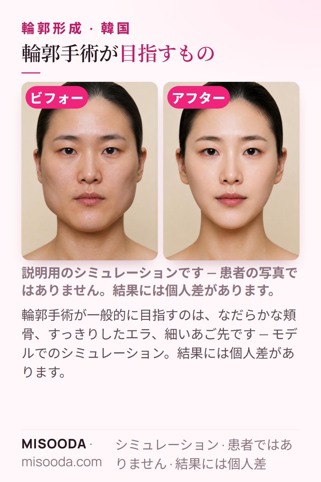 韓国の輪郭手術が一般的に目指す変化のイラスト — なだらかな頬骨、すっきりしたエラ、細いあご先。モデルによるシミュレーションで、患者ではありません