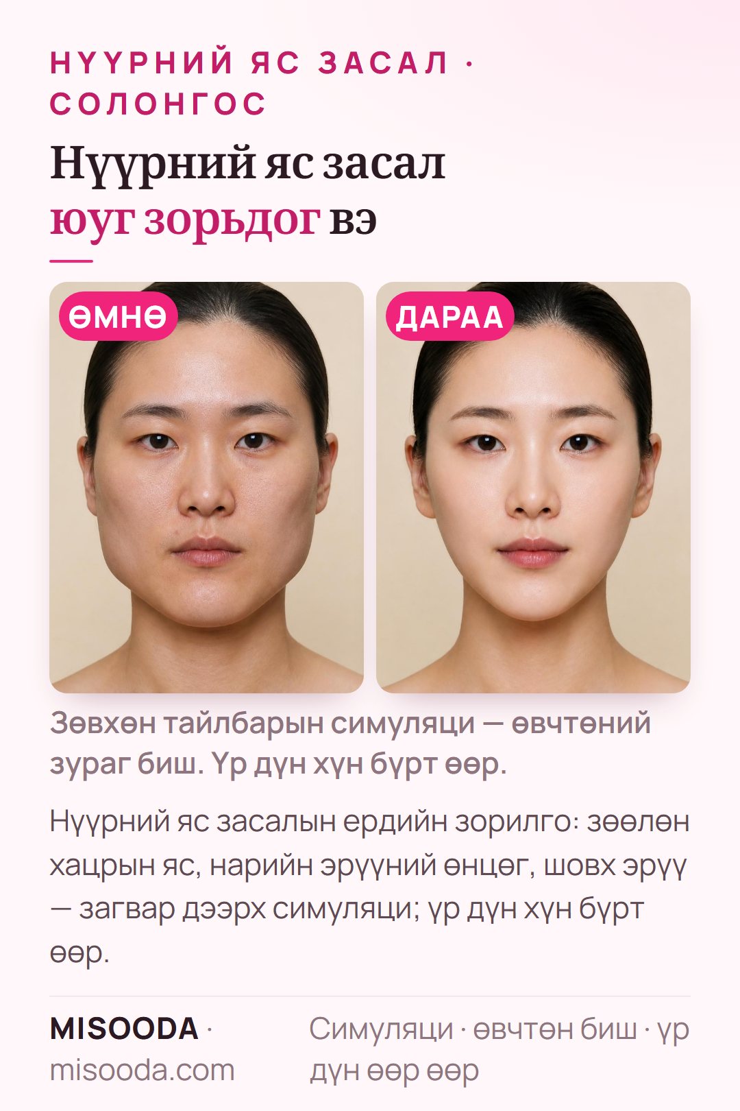 Нүүрний яс засалын ердийн зорилгын зураг — зөөлөн хацрын яс, нарийн эрүүний өнцөг, шовх эрүү — загвар дээрх симуляци