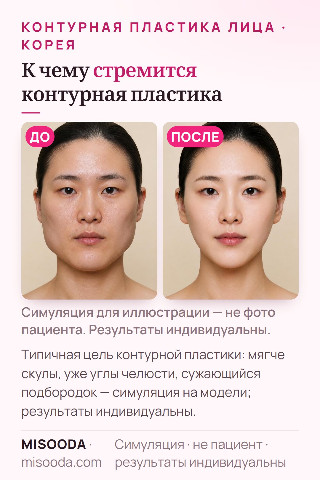 Иллюстрация типичных целей контурной пластики лица — более мягкие скулы, узкие углы челюсти и заострённый подбородок — смоделировано на модели