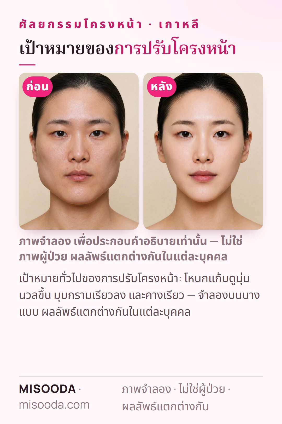 ภาพประกอบเป้าหมายทั่วไปของศัลยกรรมปรับโครงหน้าที่เกาหลี — โหนกแก้มนุ่มนวลขึ้น มุมกรามเรียวลง และคางเรียว — จำลองบนนางแบบ