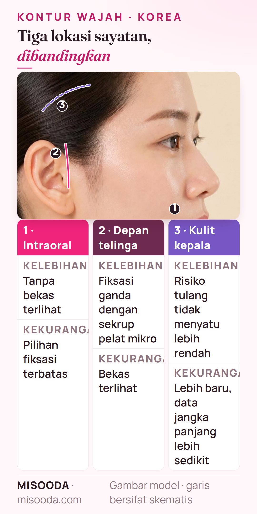 Perbandingan lokasi sayatan kontur wajah: intraoral tanpa bekas terlihat, depan telinga dengan fiksasi ganda pelat mikro, dan sayatan kulit kepala