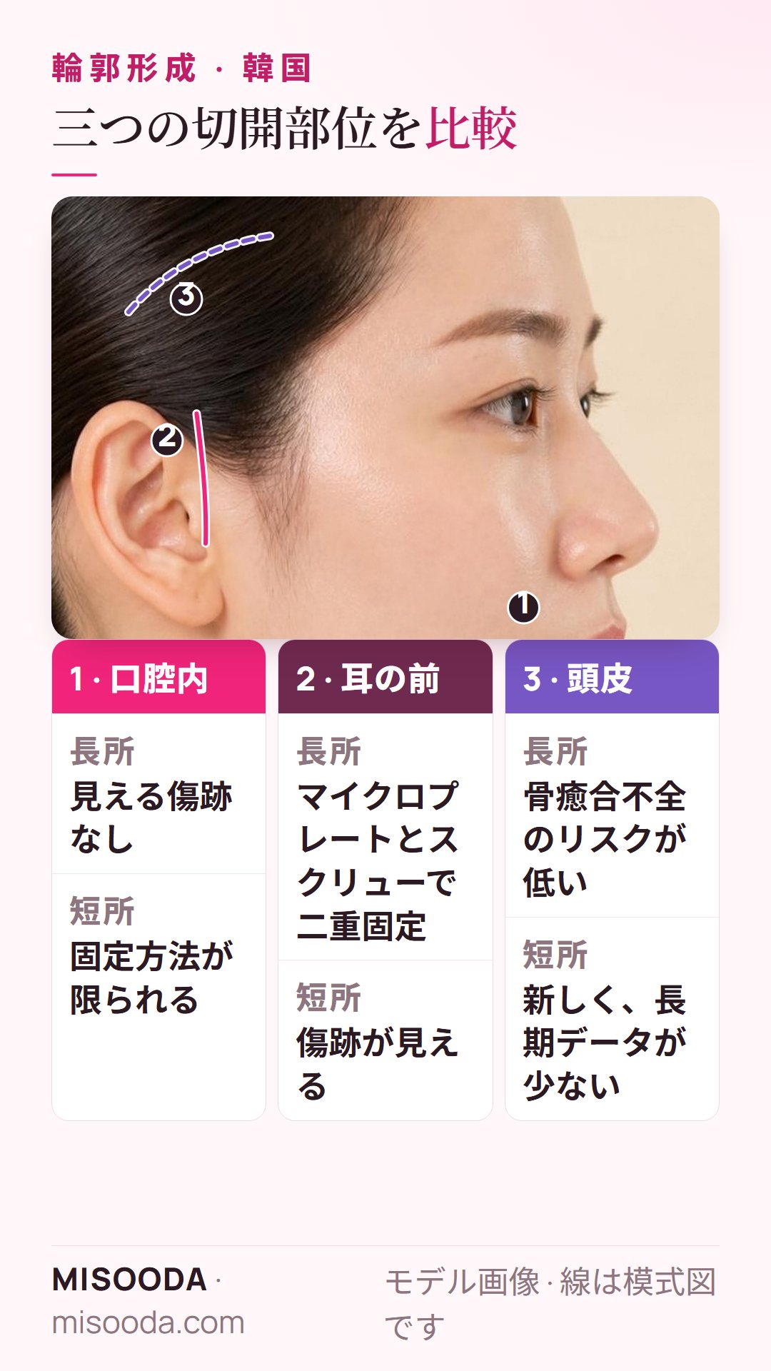 韓国 輪郭形成の切開部位の比較:見える傷跡がない口腔内、マイクロプレートで二重固定する耳の前、頭皮切開