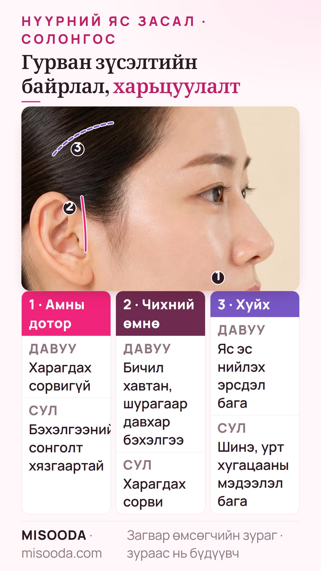Нүүрний яс засалын зүсэлтийн байрлалын харьцуулалт: харагдах сорвигүй амны дотор, чихний өмнө бичил хавтангаар давхар бэхэлгээ, хуйхны зүсэлт