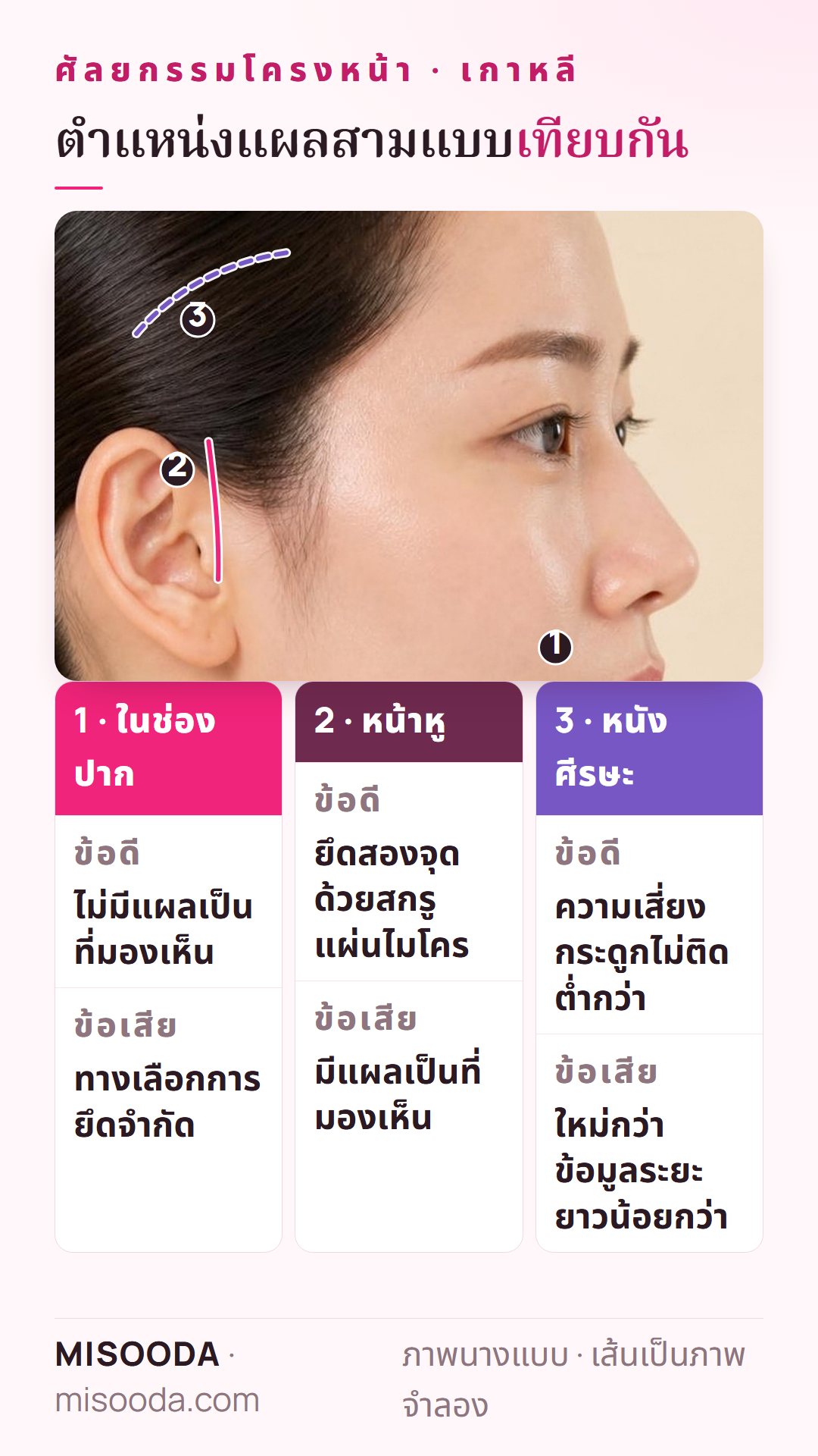 เทียบตำแหน่งแผลศัลยกรรมโครงหน้า: ในช่องปากไม่มีแผลเป็นที่เห็น หน้าหูยึดสองจุดด้วยแผ่นไมโคร และแผลที่หนังศีรษะ