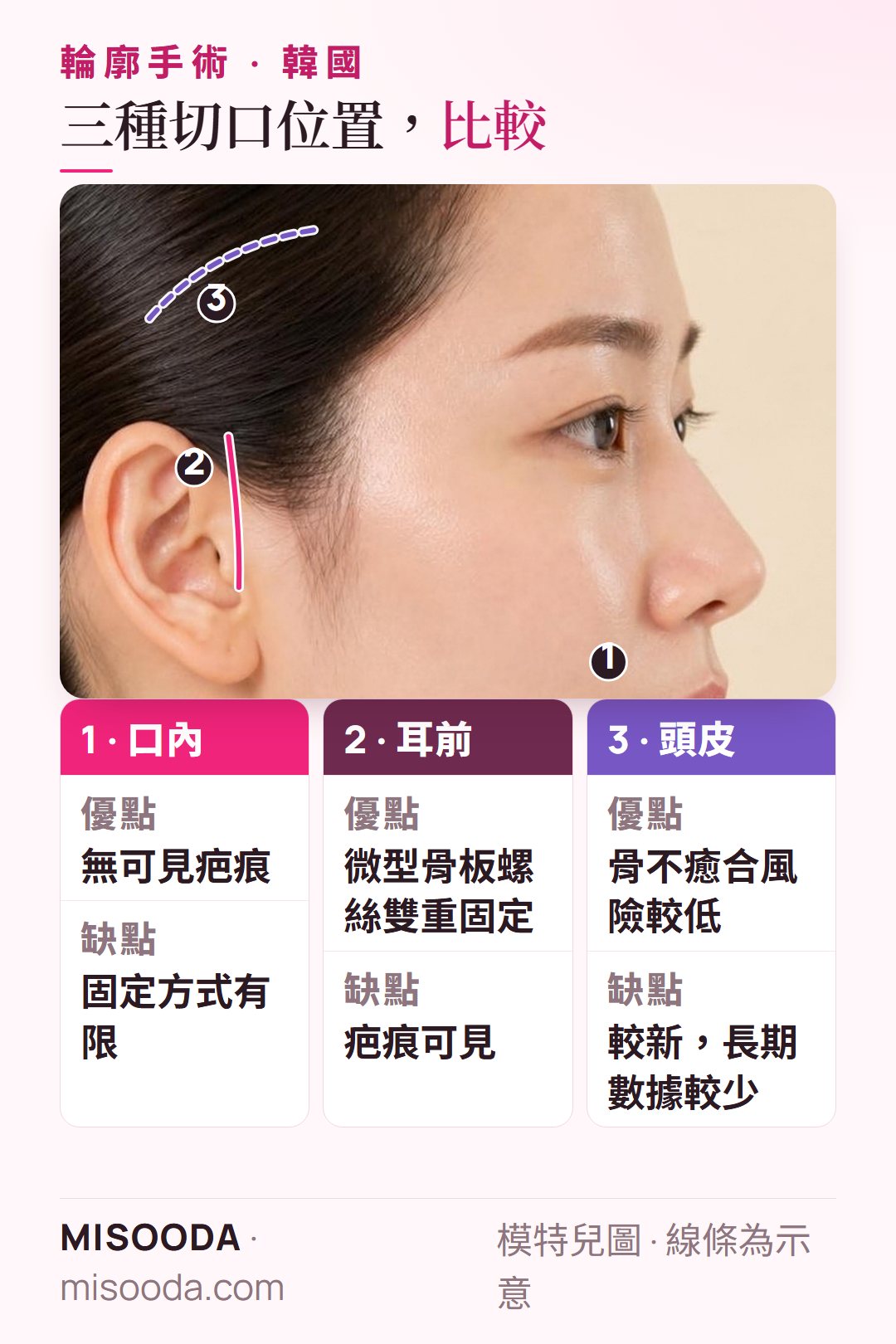 韓國 輪廓手術切口位置比較:口內切口無可見疤痕、耳前切口可微型骨板雙重固定,以及頭皮切口