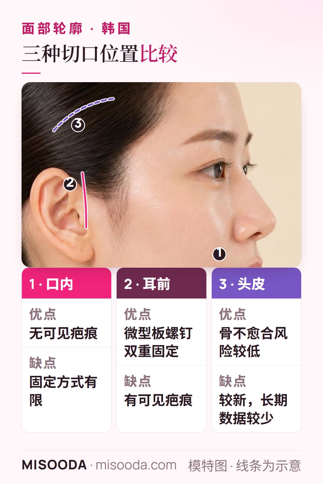 韩国 面部轮廓切口位置对比:口内切口无可见疤痕,耳前切口可用微型板双重固定,以及头皮切口