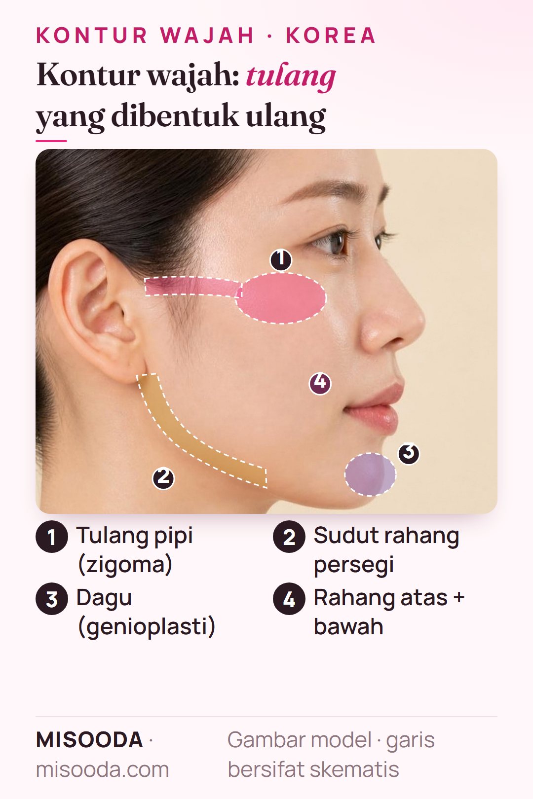 Operasi kontur wajah di Korea pada profil samping: tulang pipi (zigoma), sudut rahang persegi, dagu serta rahang atas dan bawah ditandai untuk dibentuk ulang