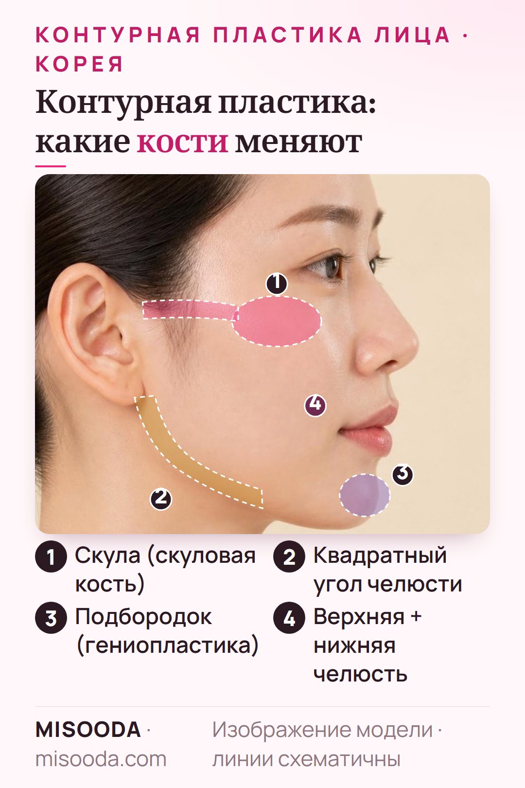 Контурная пластика лица в Корее, вид сбоку: скула (скуловая кость), угол нижней челюсти, подбородок, верхняя и нижняя челюсть отмечены как зоны коррекции костей