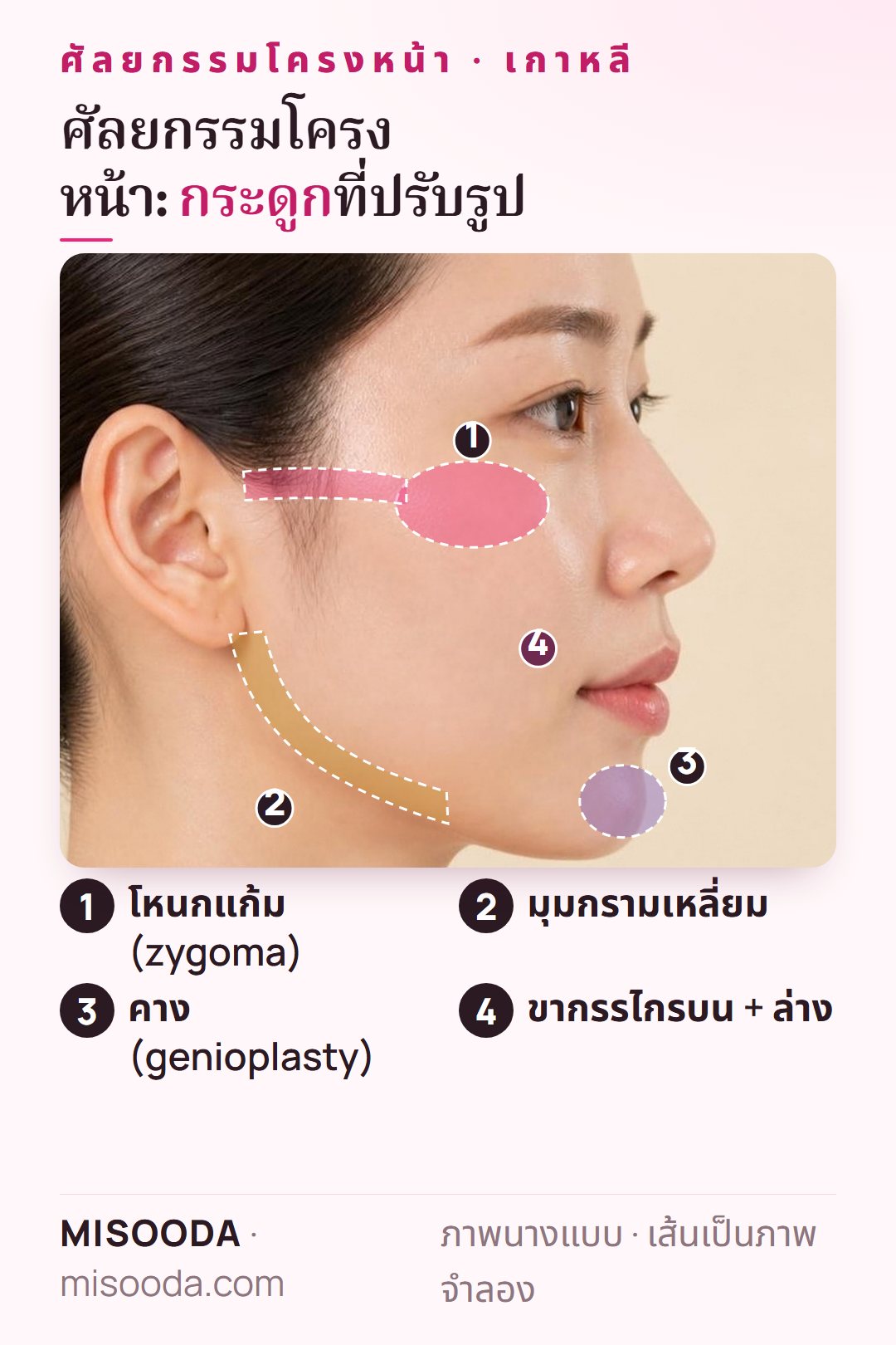 ศัลยกรรมโครงหน้า เกาหลี บนภาพด้านข้าง: โหนกแก้ม (zygoma) มุมกรามเหลี่ยม คาง และขากรรไกรบนและล่าง ที่ปรับรูปกระดูก