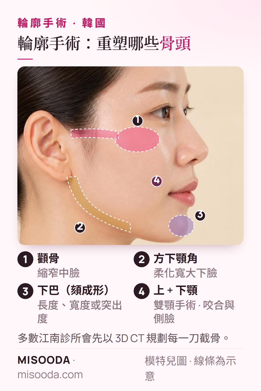 韓國 輪廓手術側臉示意:標示顴骨、方下顎角、下巴(頦成形)與上下顎等需要骨骼重塑的部位