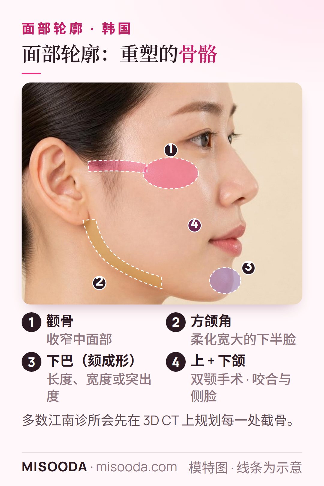 韩国 面部轮廓手术侧脸图解:标出需要骨骼重塑的颧骨、方颌角、下巴(颏成形)以及上下颌(双颚)等部位