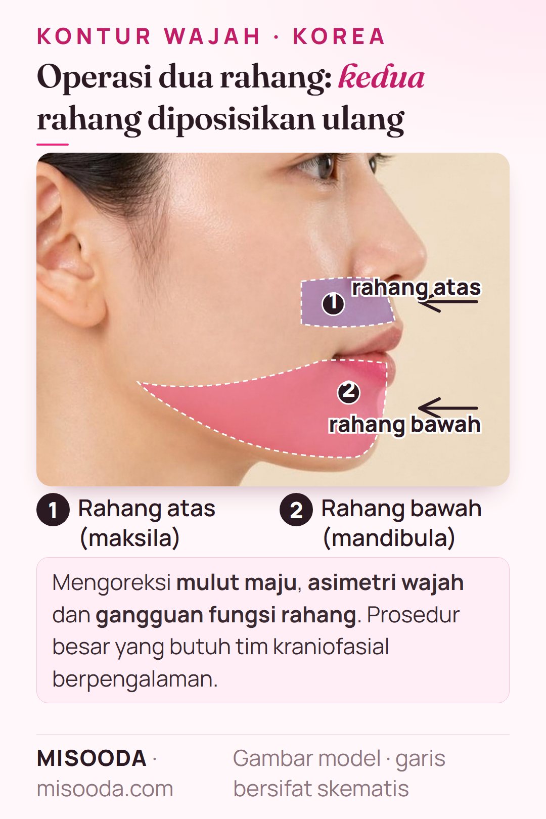 Operasi dua rahang (ortognatik) di Korea: rahang atas (maksila) dan rahang bawah (mandibula) diposisikan ulang untuk mengoreksi mulut maju, asimetri dan fungsi rahang