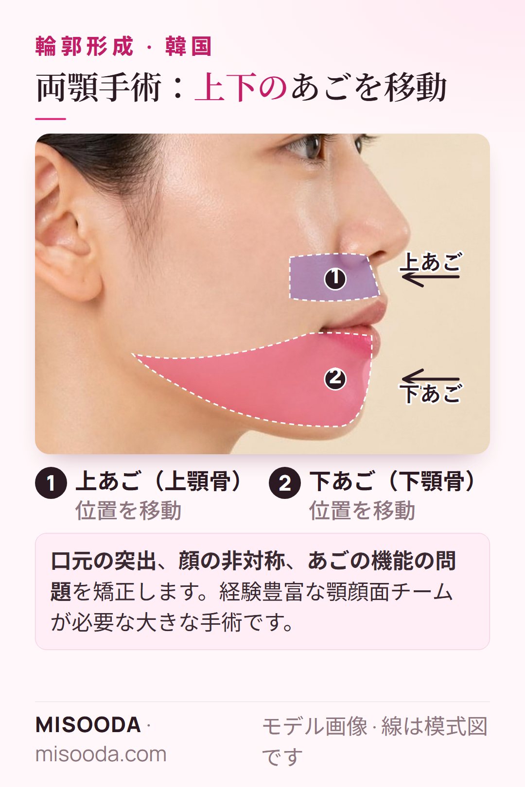 韓国 両顎手術(顎矯正):上あご(上顎骨)と下あご(下顎骨)を移動し、口元の突出、非対称、あごの機能を矯正