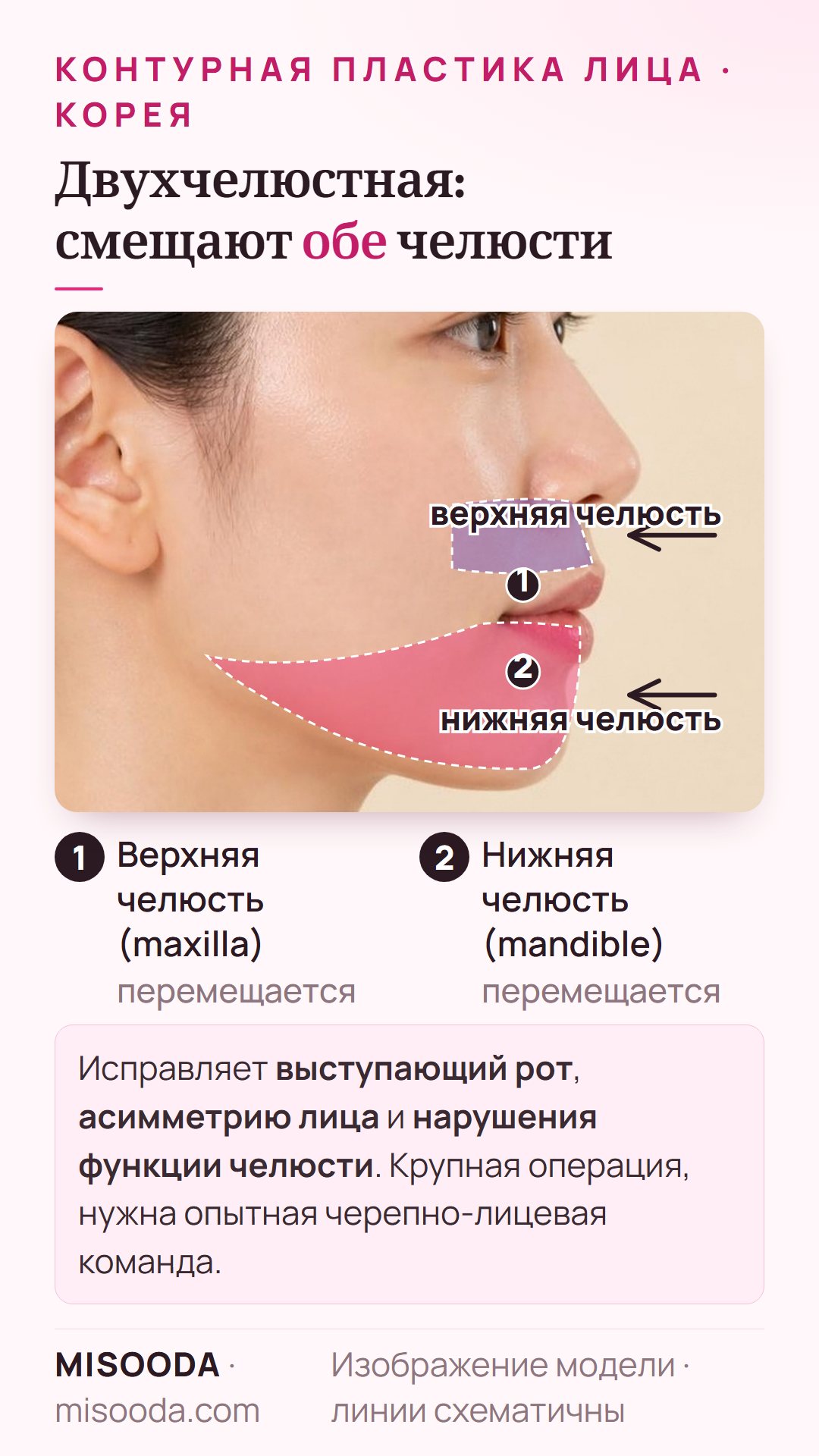 Двухчелюстная (ортогнатическая) операция в Корее: верхняя челюсть (максилла) и нижняя челюсть (мандибула) перемещаются для коррекции выступающего рта, асимметрии и функции челюсти