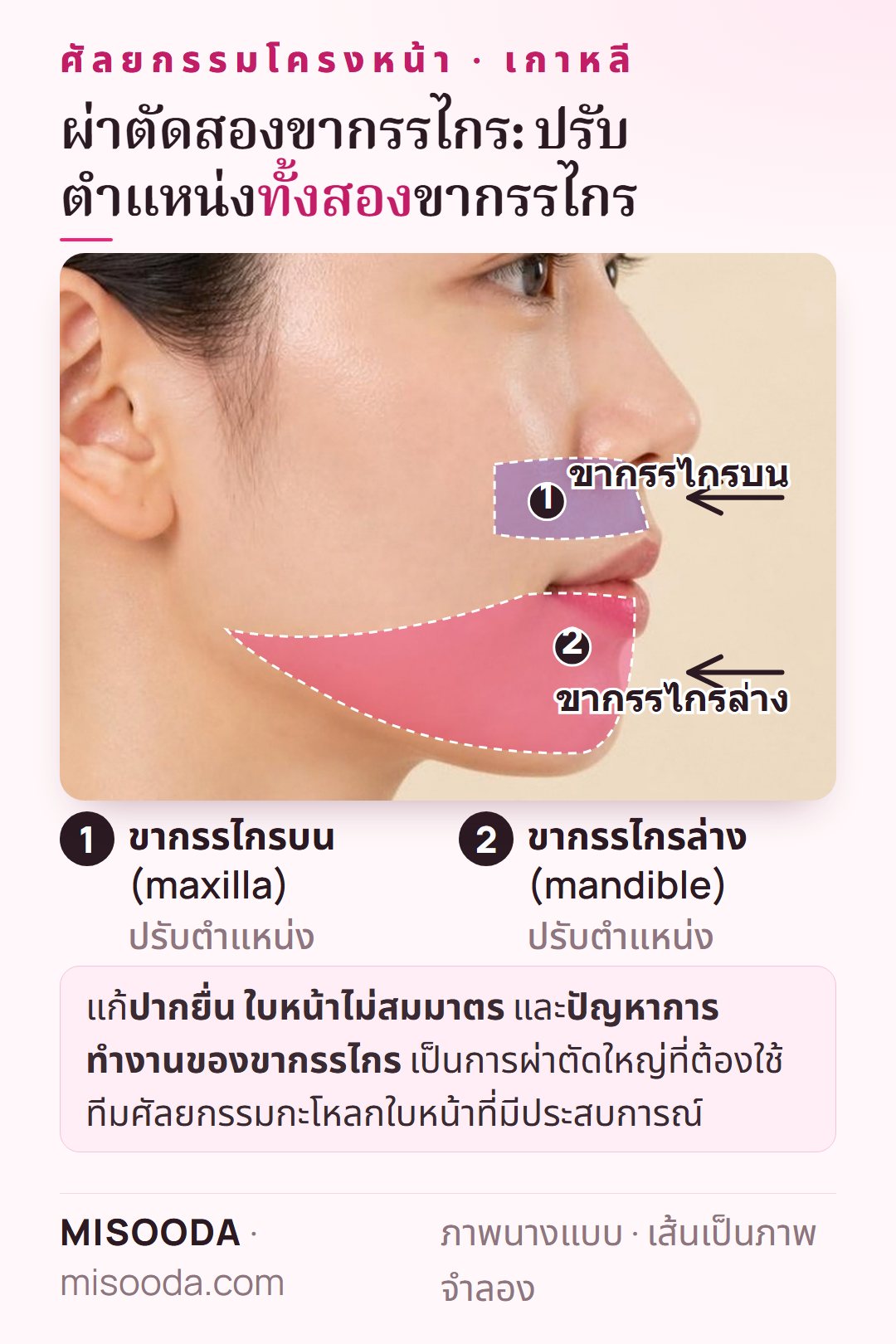 ผ่าตัดสองขากรรไกรในเกาหลี: ปรับตำแหน่งขากรรไกรบน (maxilla) และล่าง (mandible) เพื่อแก้ปากยื่น ใบหน้าไม่สมมาตร และการทำงานของขากรรไกร