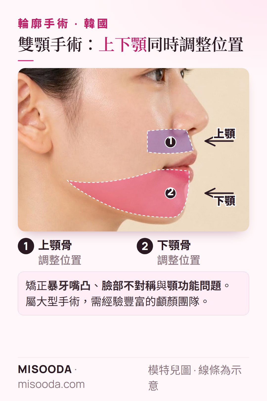 韓國 雙顎(正顎)手術:同時調整上顎骨與下顎骨位置,矯正嘴凸、臉部不對稱與顎功能問題
