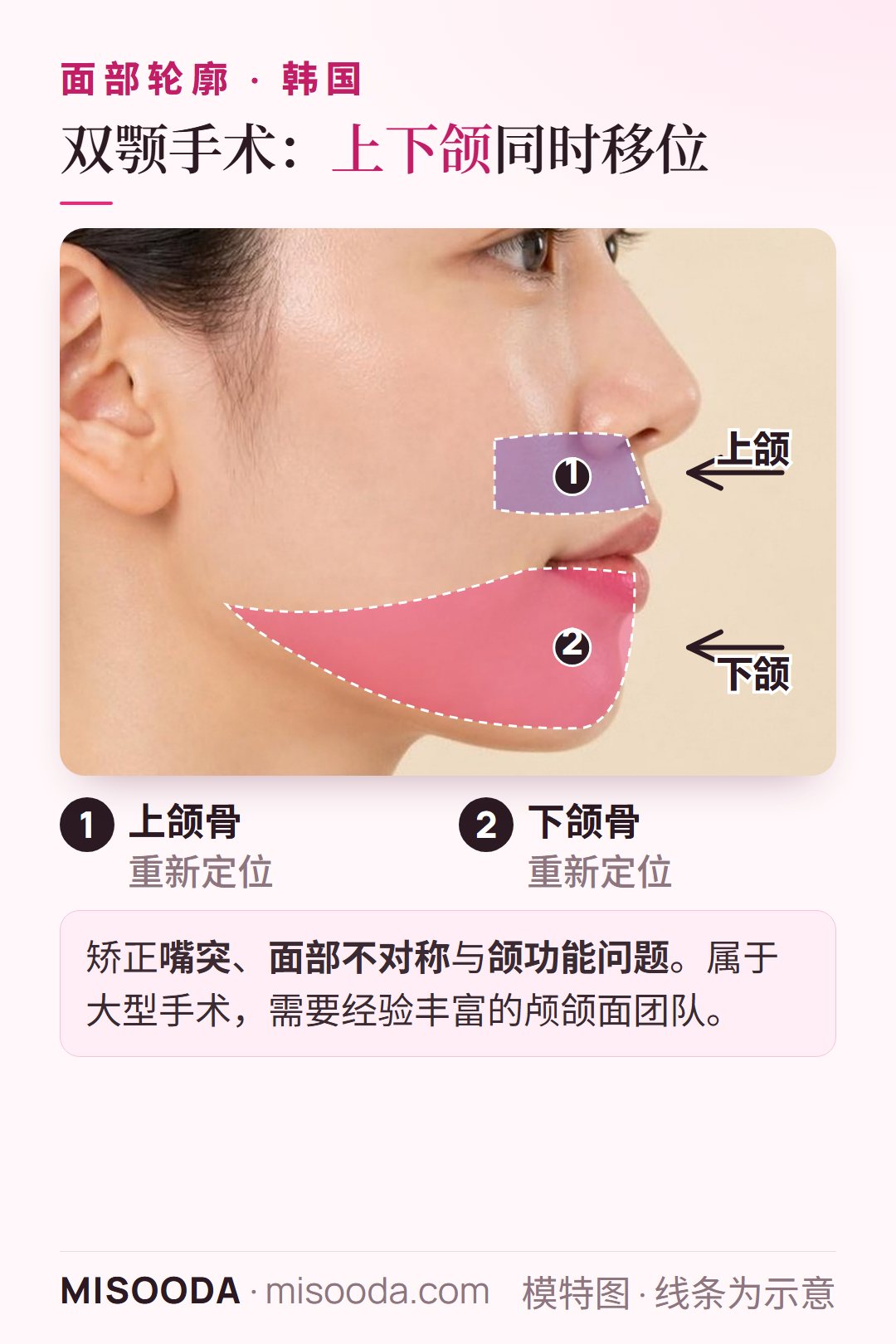 韩国 双颚(正颌)手术:重新定位上颌骨与下颌骨,矫正嘴突、面部不对称与颌功能问题