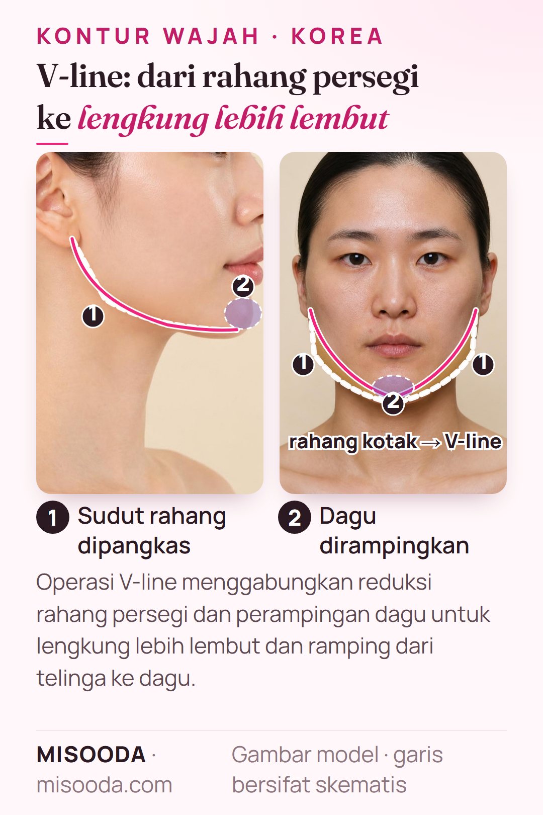 Operasi V-line di Korea: sudut rahang persegi dipangkas di kedua sisi dan dagu dirampingkan menjadi bentuk V, pada profil samping dan skema tampak depan