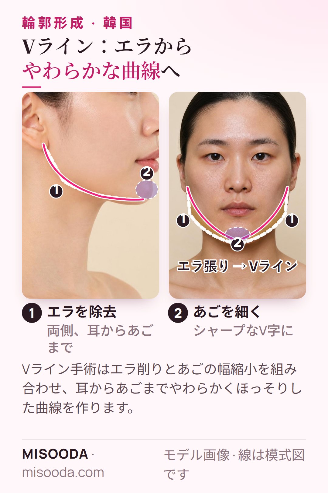 韓国 Vライン手術:両側のエラを除去し、あごをV字に細くする様子を横顔と正面の模式図で図示