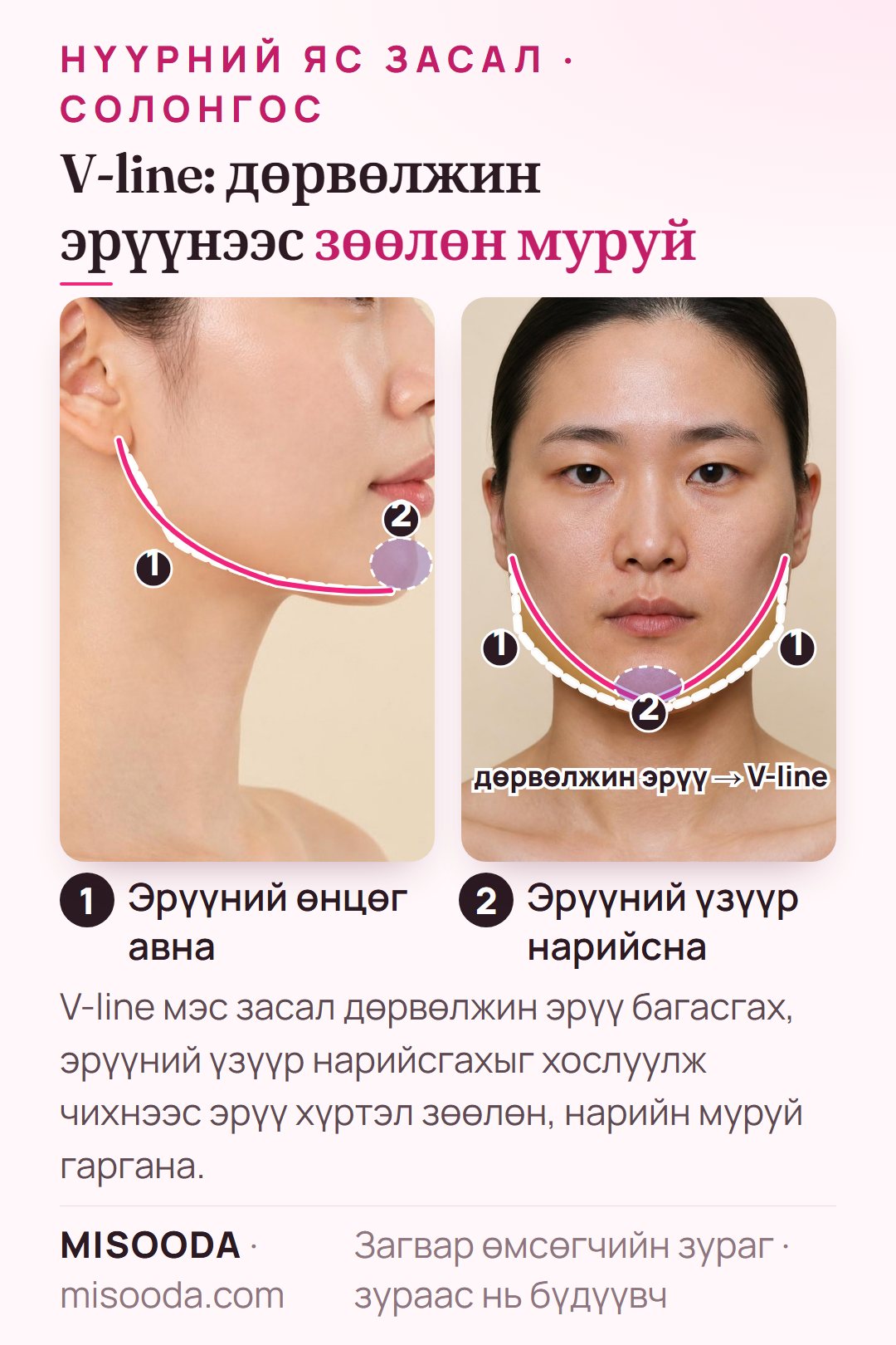 Солонгост V-line мэс засал: хоёр талын дөрвөлжин эрүүний өнцгийг авч, эрүүний үзүүрийг V хэлбэрт нарийсгана — хажуу ба урд талын бүдүүвч