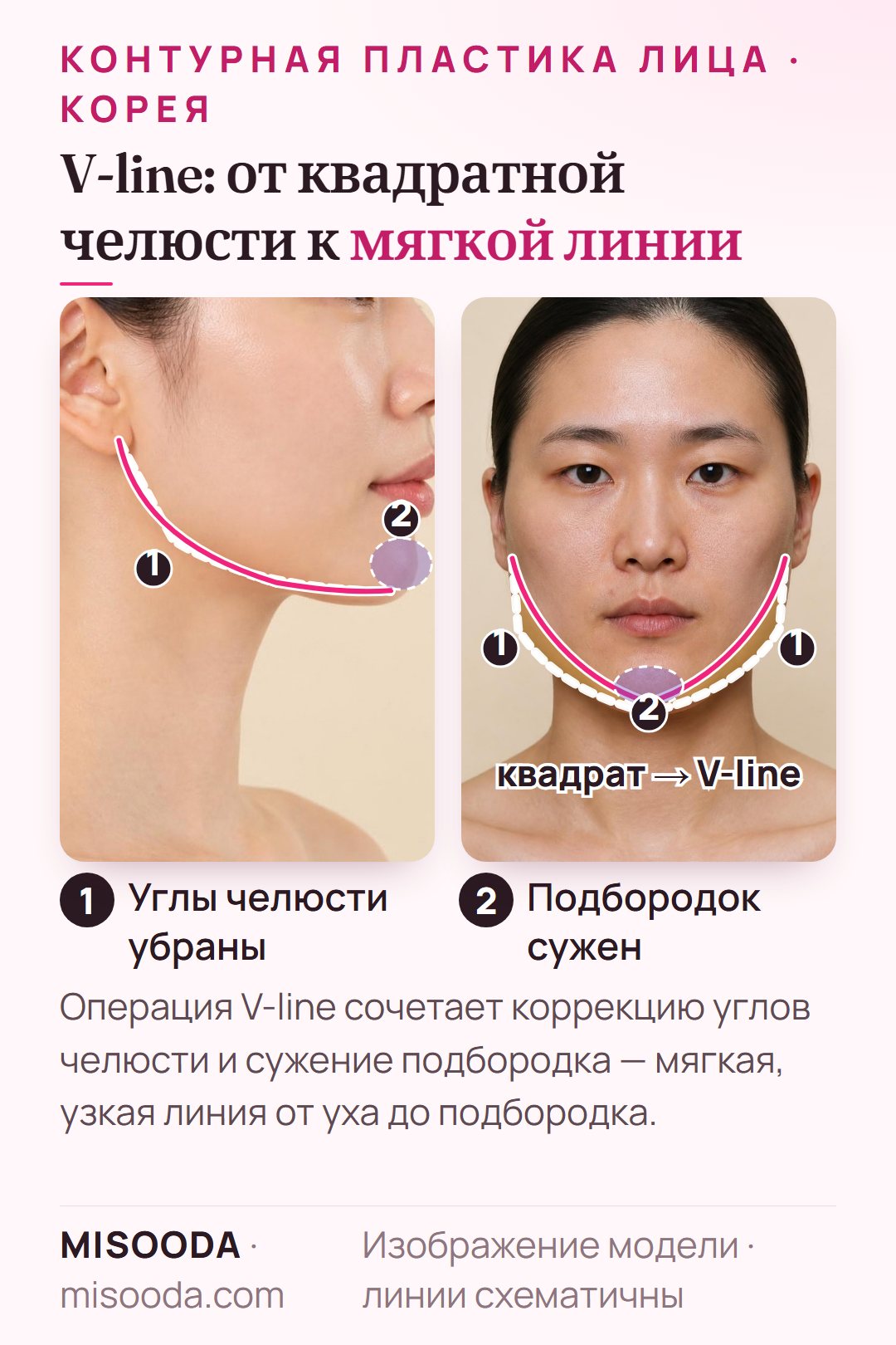 Операция V-line в Корее: углы нижней челюсти удаляются с обеих сторон, подбородок сужается в форму V — на схеме в профиль и анфас