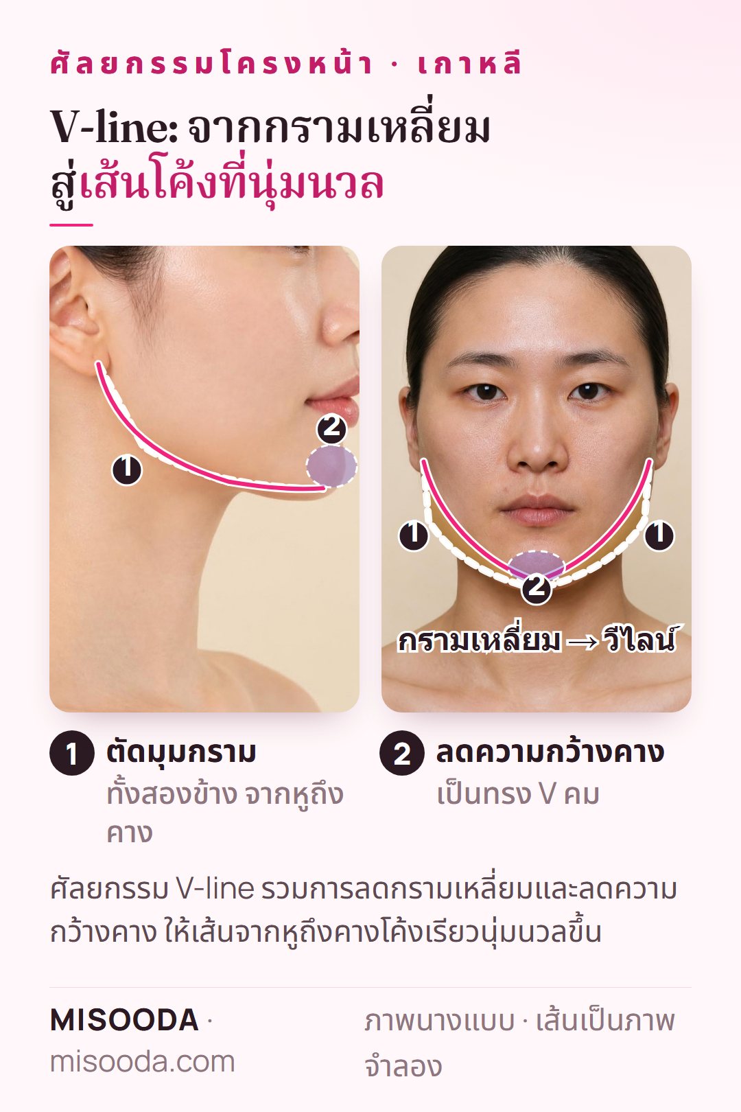 ศัลยกรรม V-line เกาหลี: ตัดมุมกรามเหลี่ยมทั้งสองข้างและลดความกว้างคางเป็นทรง V แสดงบนภาพด้านข้างและภาพจำลองด้านหน้า