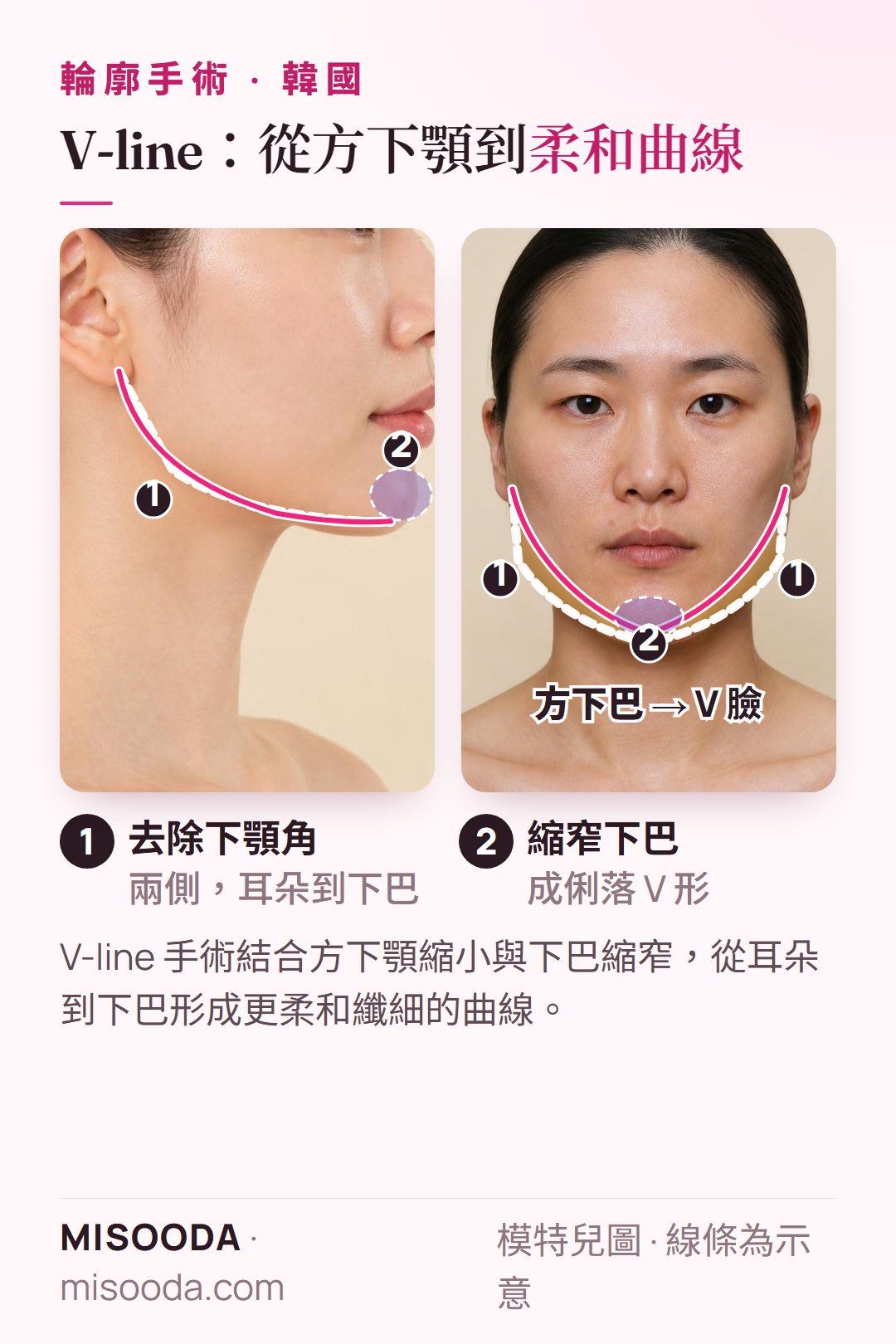 韓國 V-line 手術:去除兩側方下顎角並將下巴縮窄成 V 形,以側臉與正面示意呈現